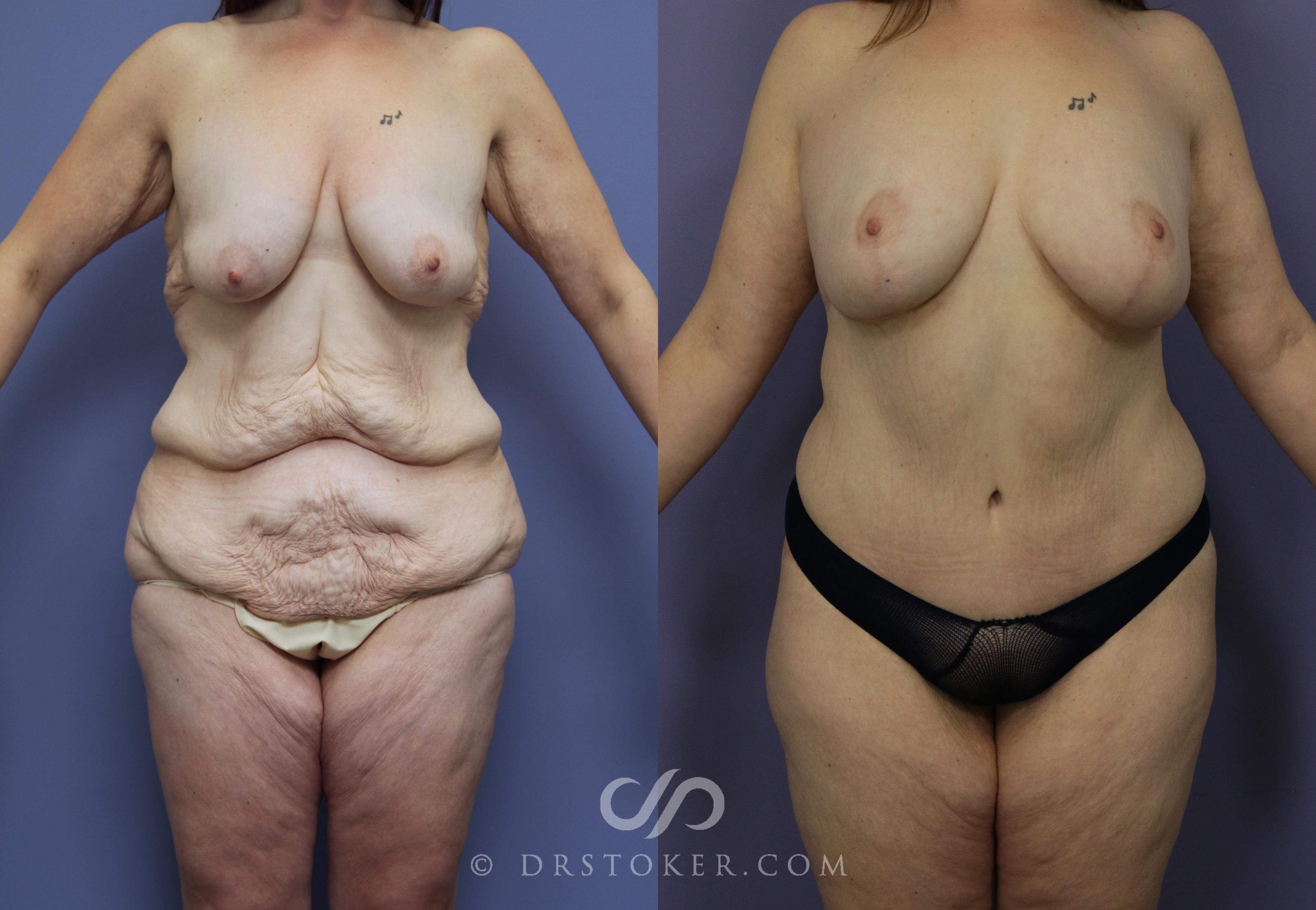 Before & After After Weight Loss Case 1047 View #1 View in Los Angeles, CA