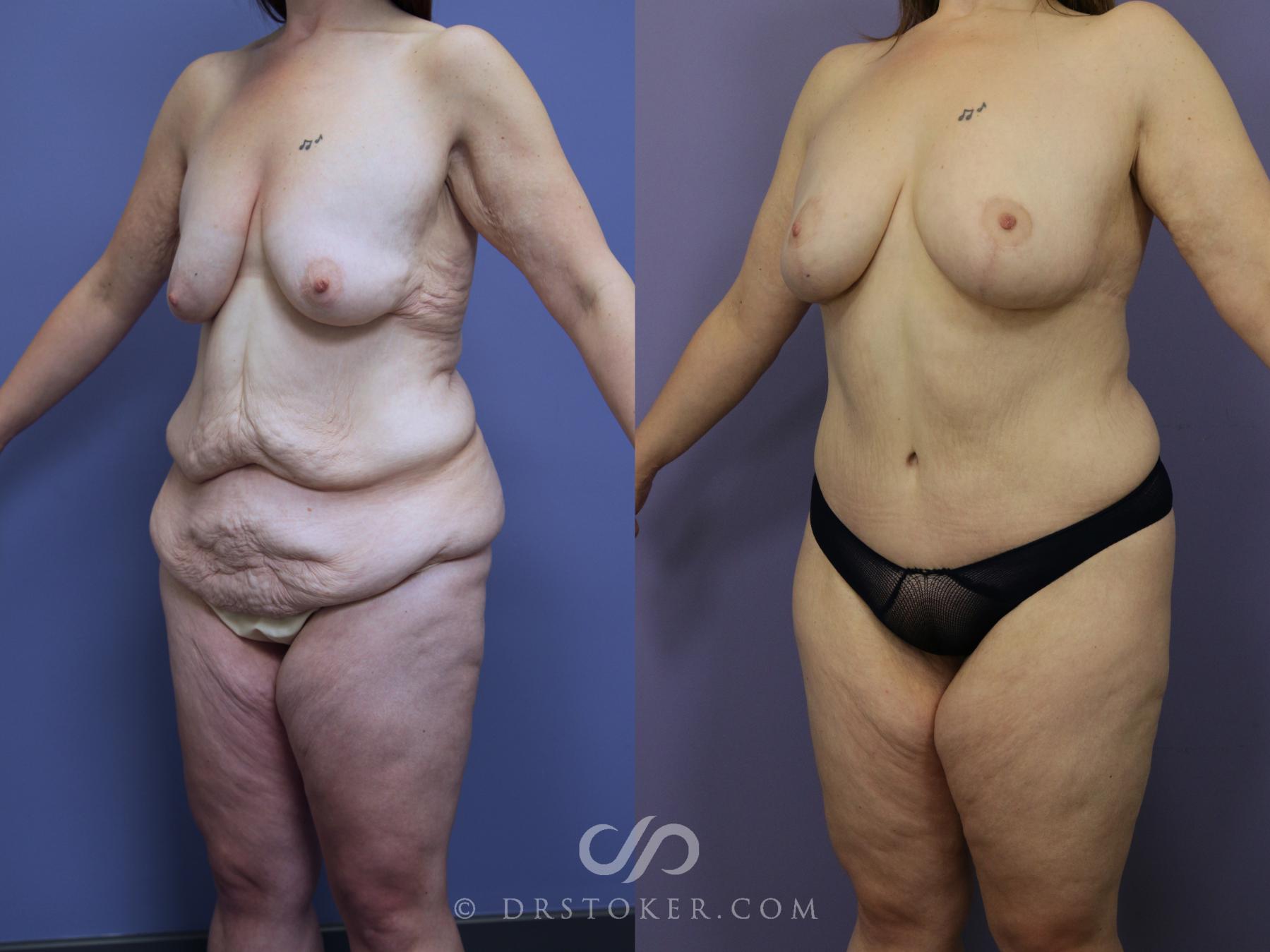 Before & After After Weight Loss Case 1047 View #2 View in Los Angeles, CA