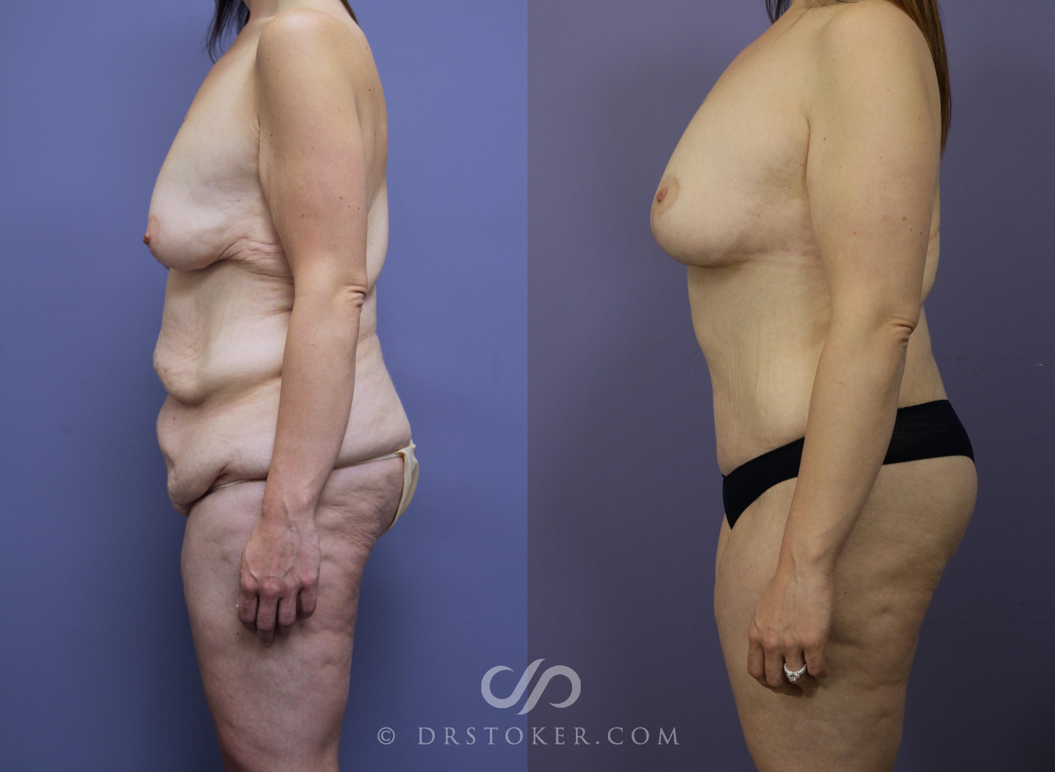 Before & After After Weight Loss Case 1047 View #3 View in Los Angeles, CA