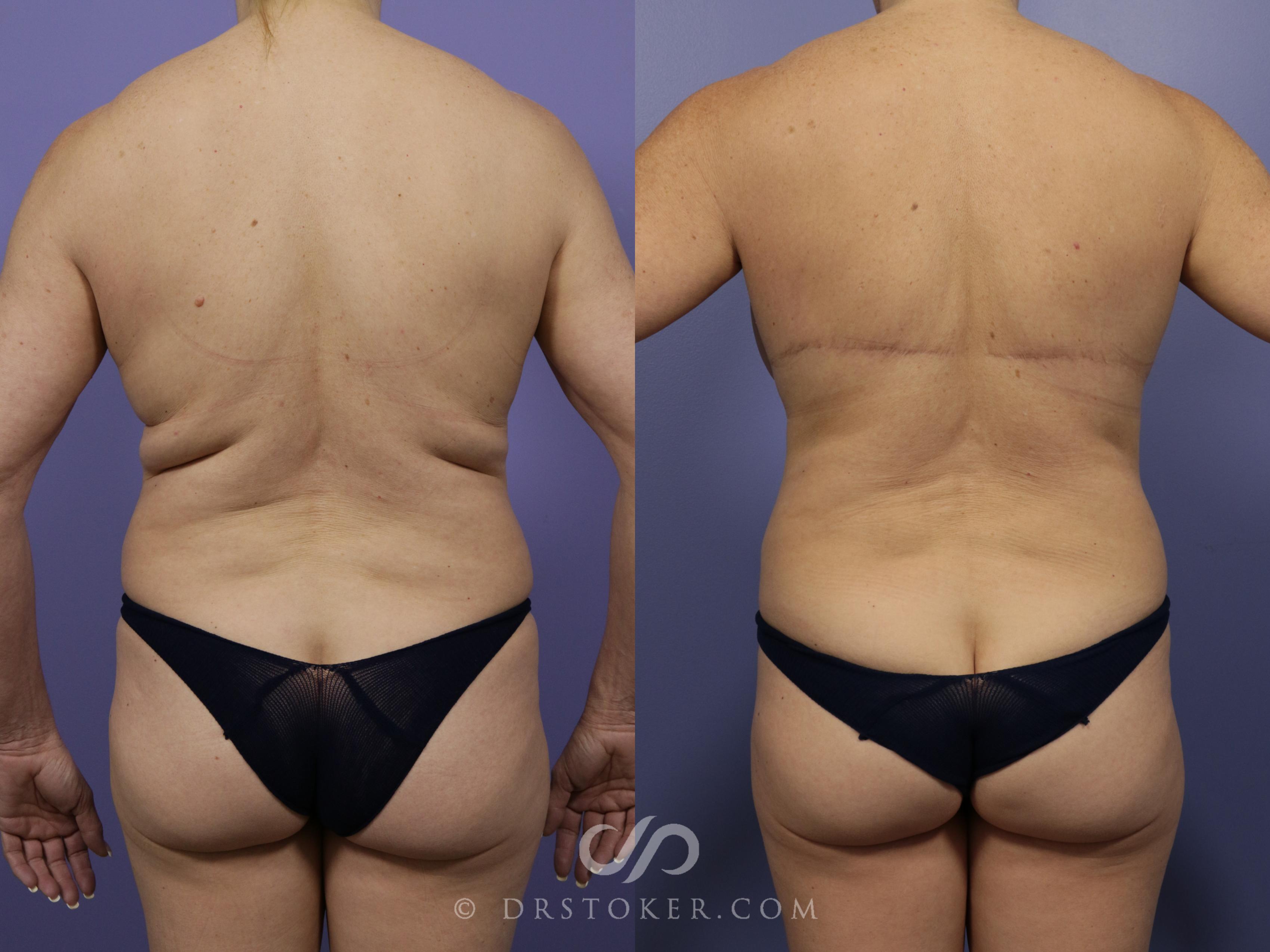 Before & After After Weight Loss Case 1048 View #1 View in Los Angeles, CA