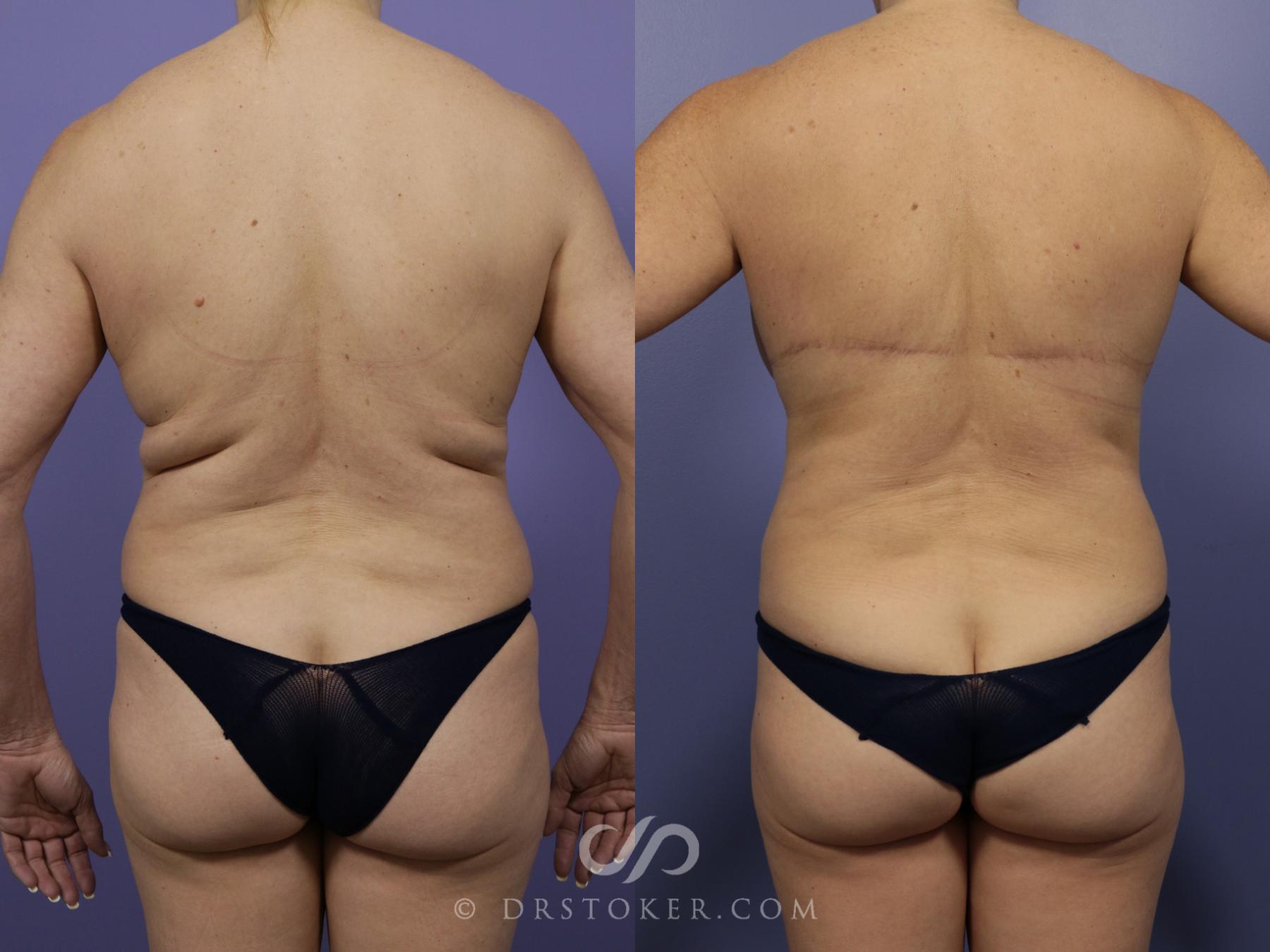Before & After After Weight Loss Case 1048 View #1 View in Los Angeles, CA
