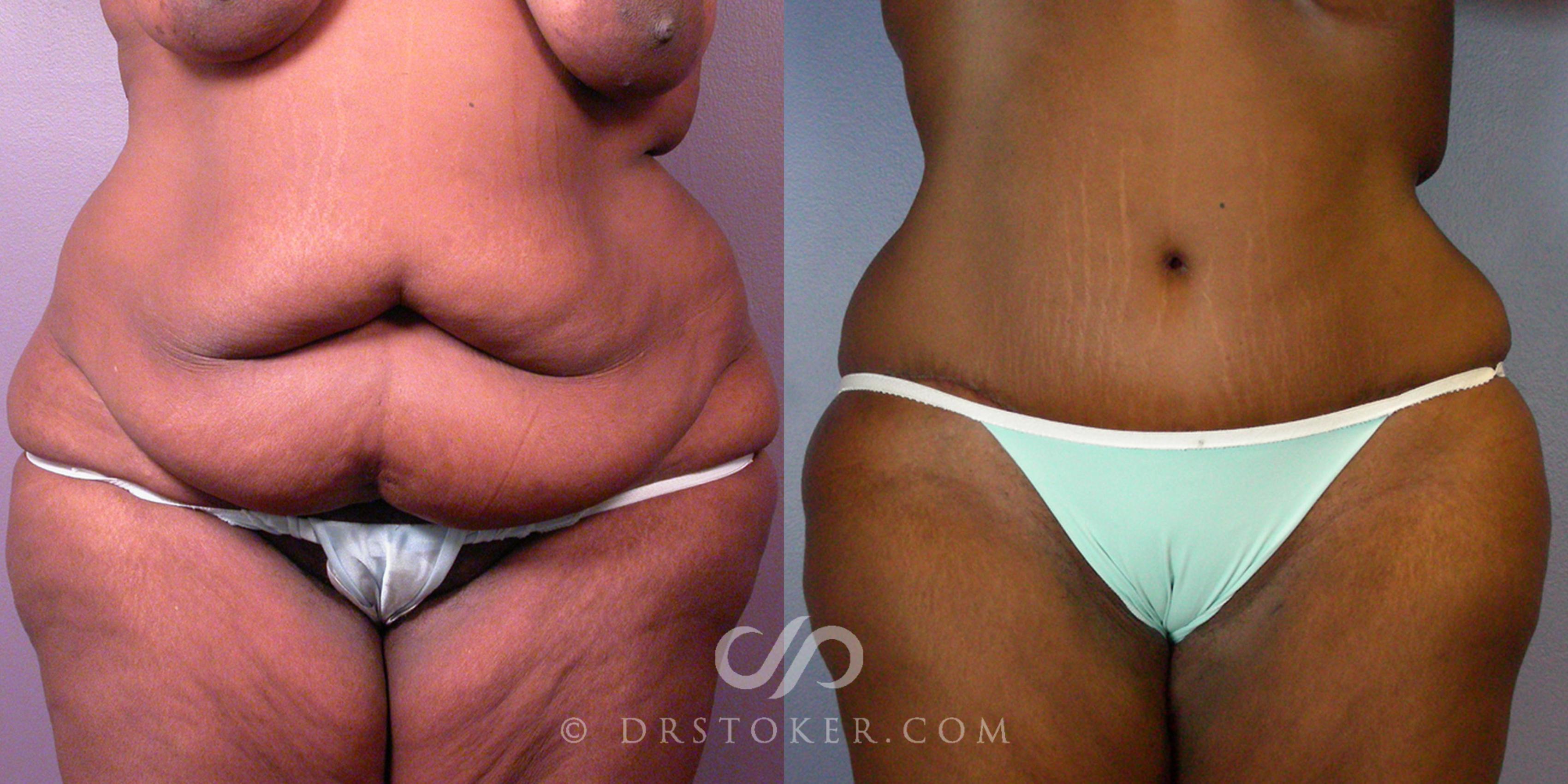 Before & After Tummy Tuck Case 108 View #1 View in Los Angeles, CA