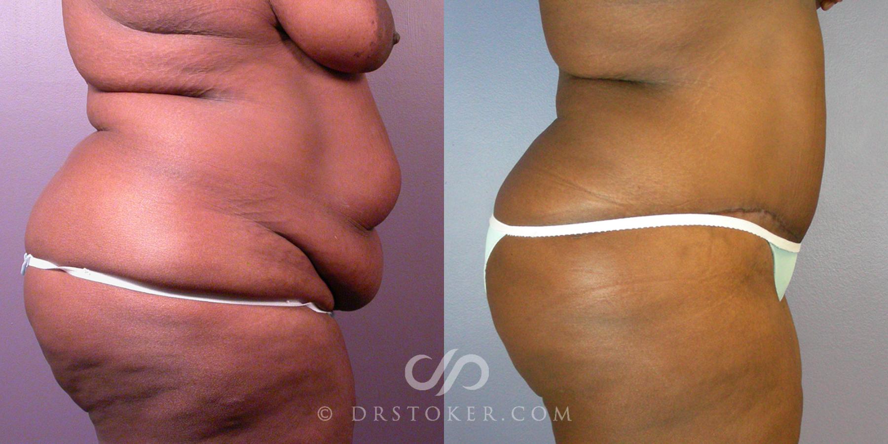 Before & After After Weight Loss Case 108 View #2 View in Los Angeles, CA