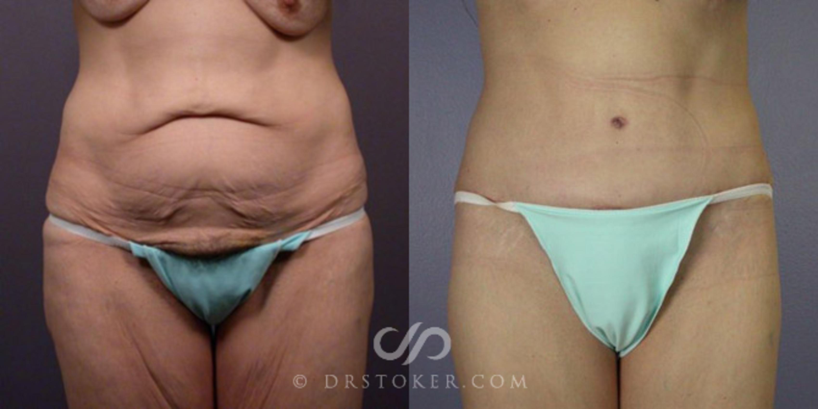 Before & After Tummy Tuck Case 111 View #1 View in Los Angeles, CA