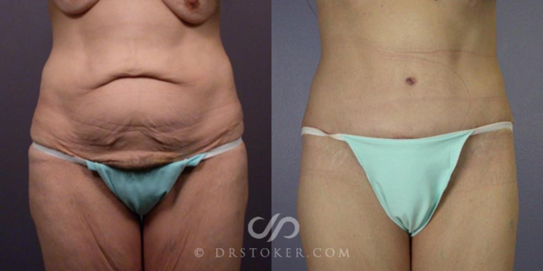 Before & After After Weight Loss Case 111 View #1 View in Los Angeles, CA