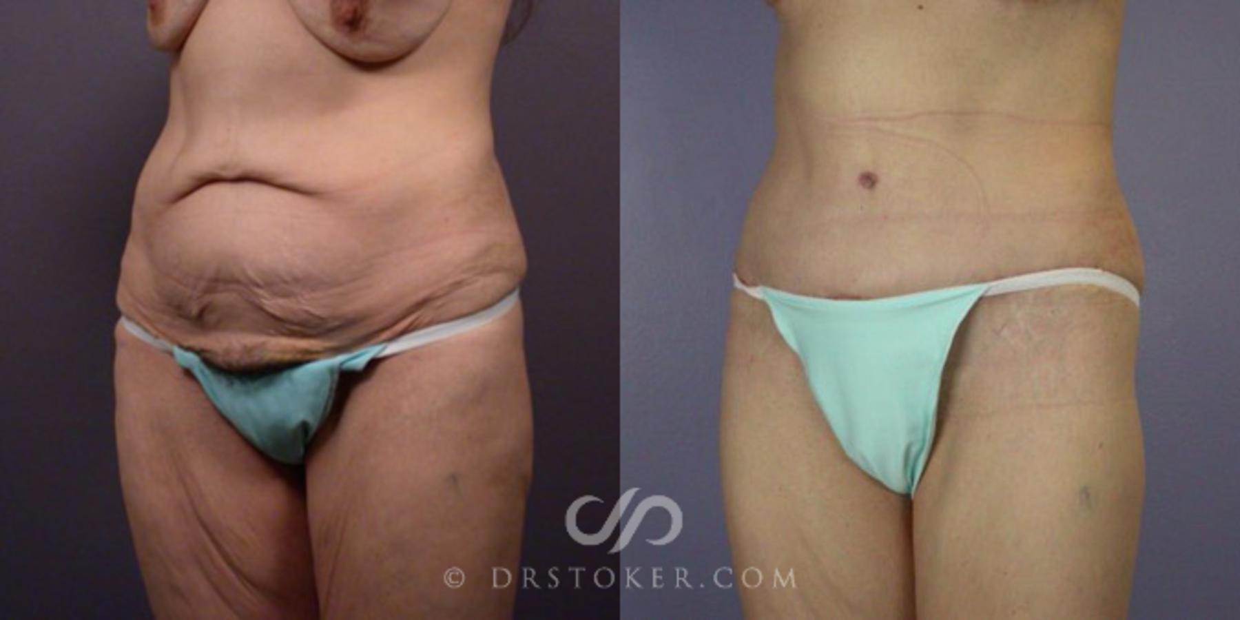 Before & After After Weight Loss Case 111 View #2 View in Los Angeles, CA