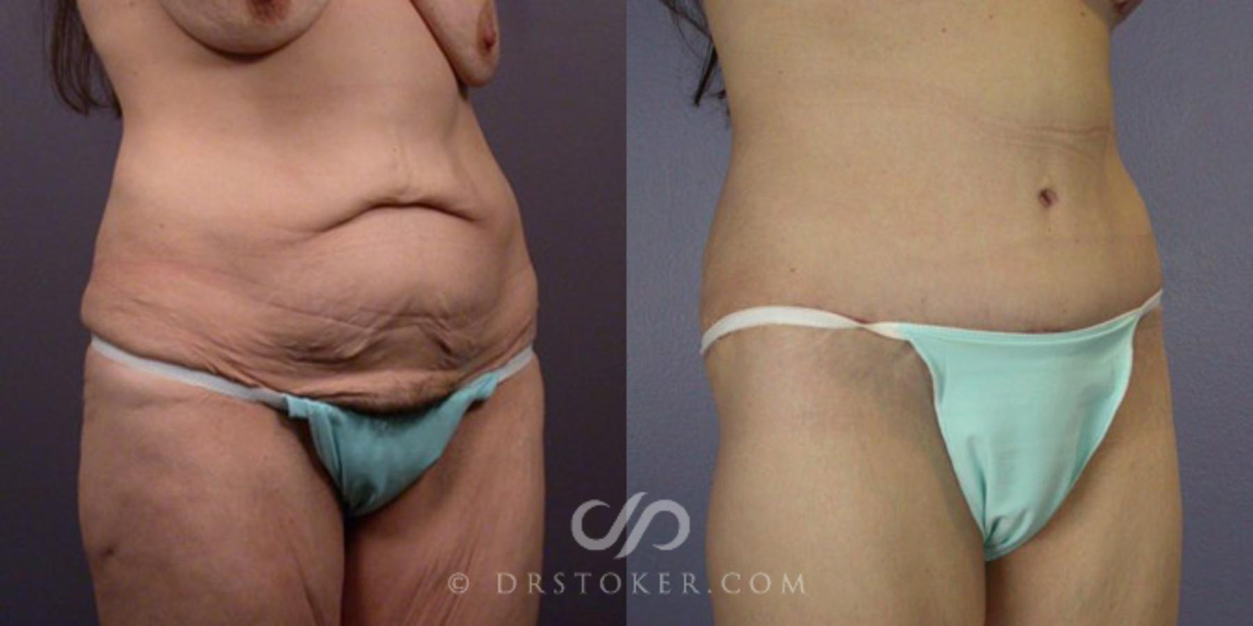 Before & After After Weight Loss Case 111 View #3 View in Los Angeles, CA