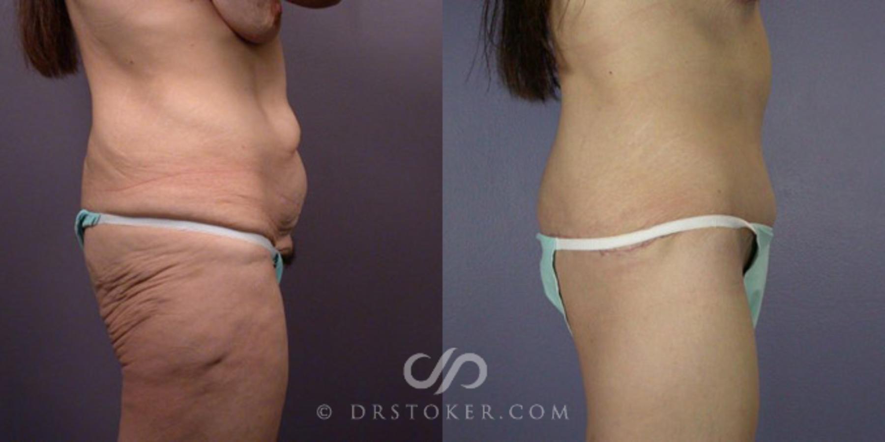 Before & After After Weight Loss Case 111 View #5 View in Los Angeles, CA