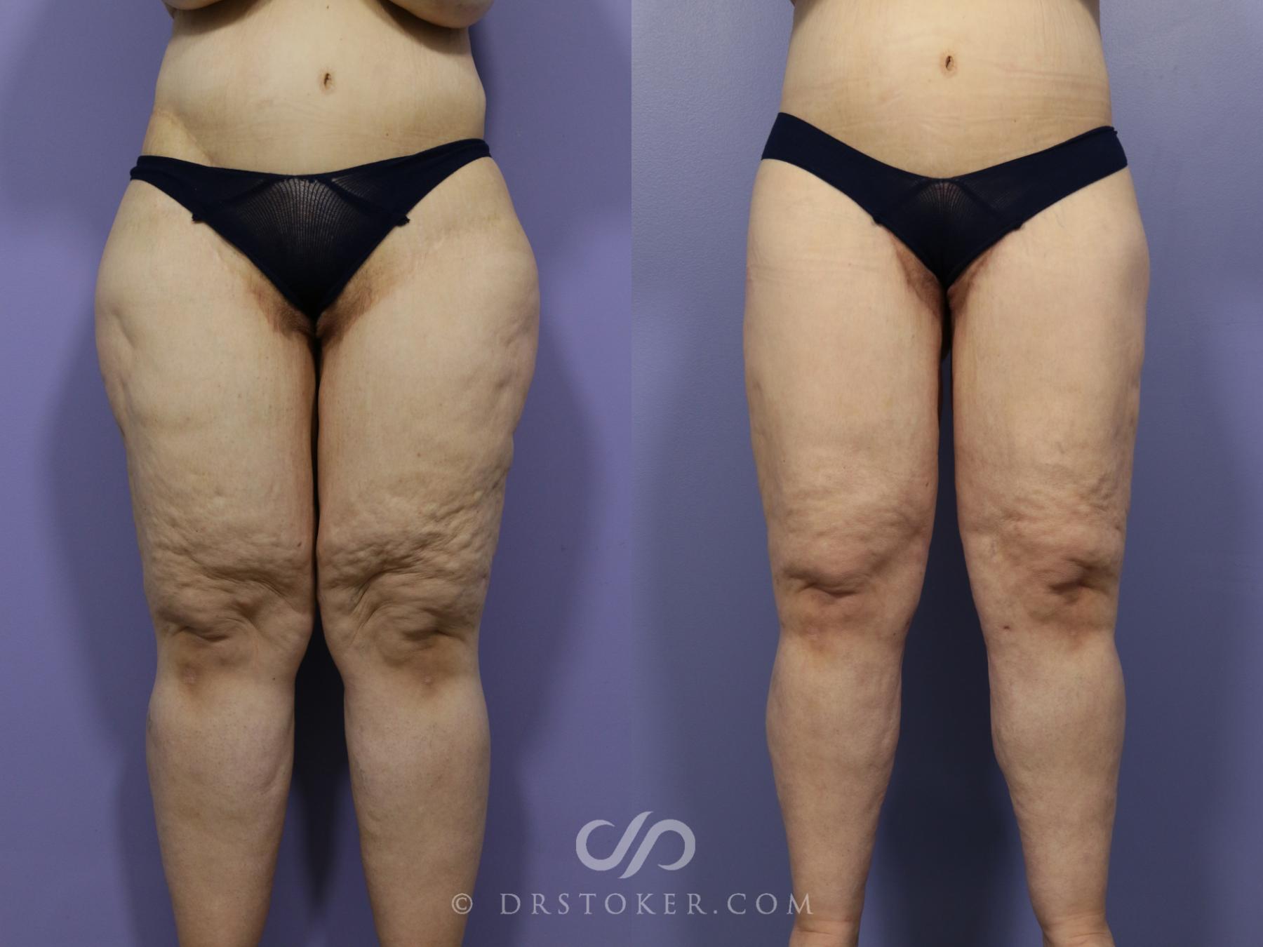 Before & After Body Lift Case 1145 View #1 View in Los Angeles, CA