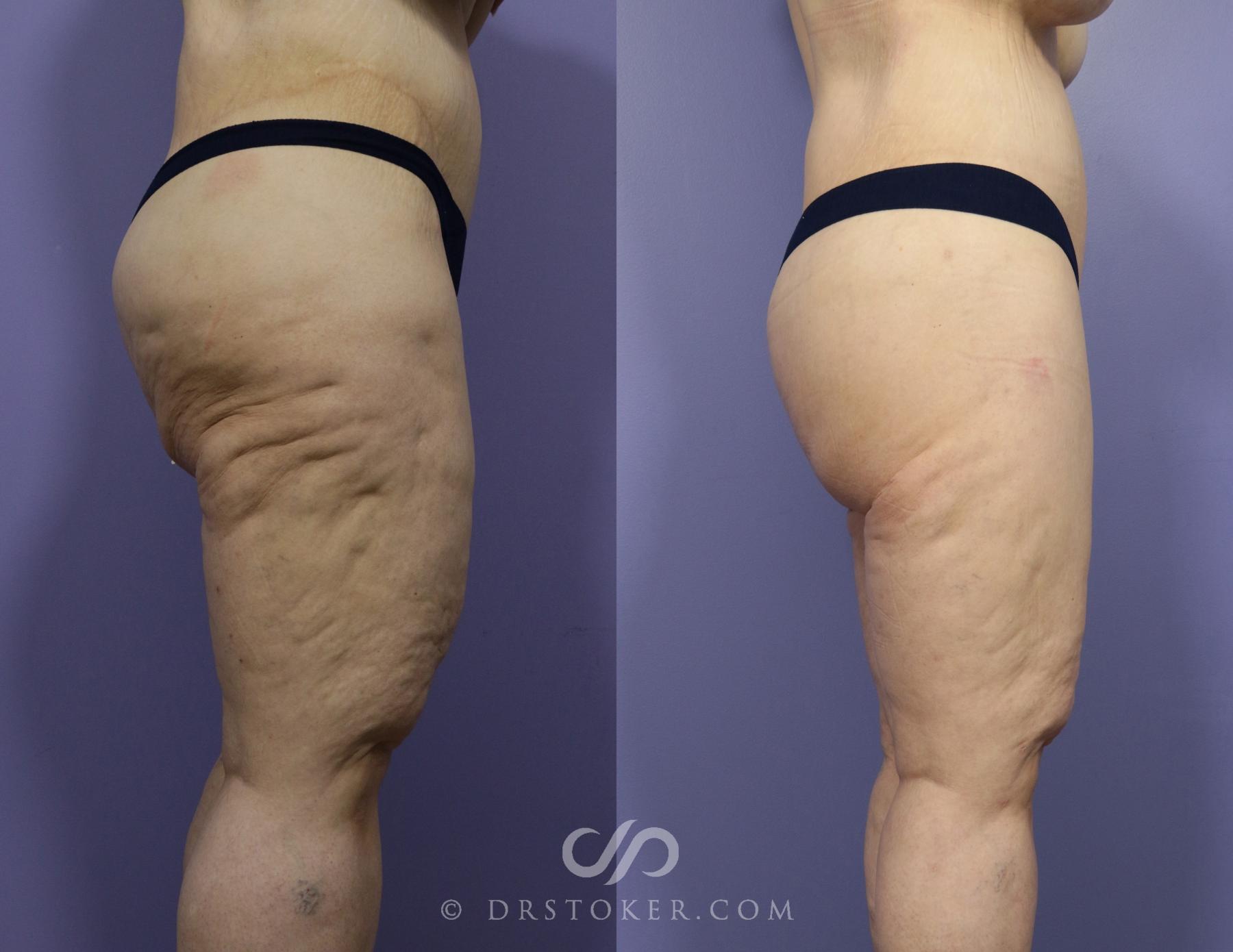 Before & After Body Lift Case 1145 View #2 View in Los Angeles, CA
