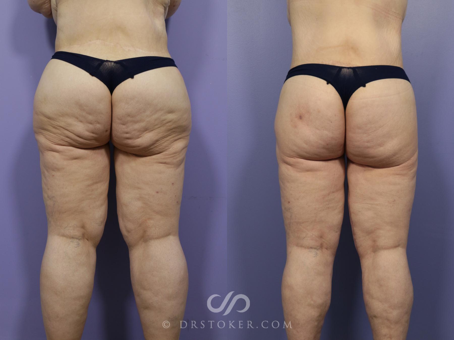 Before & After After Weight Loss Case 1147 View #1 View in Los Angeles, CA
