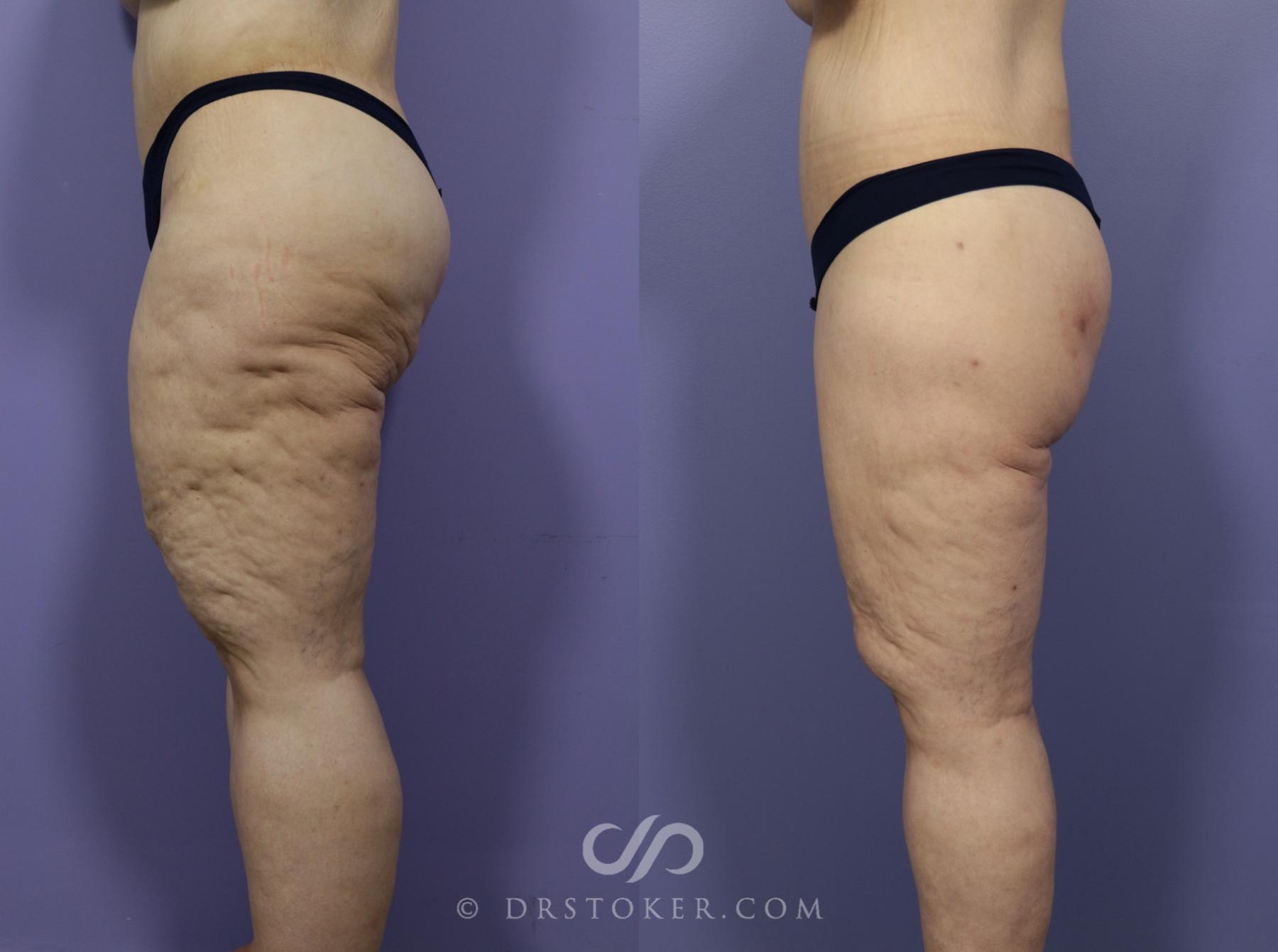 Before & After After Weight Loss Case 1147 View #2 View in Los Angeles, CA