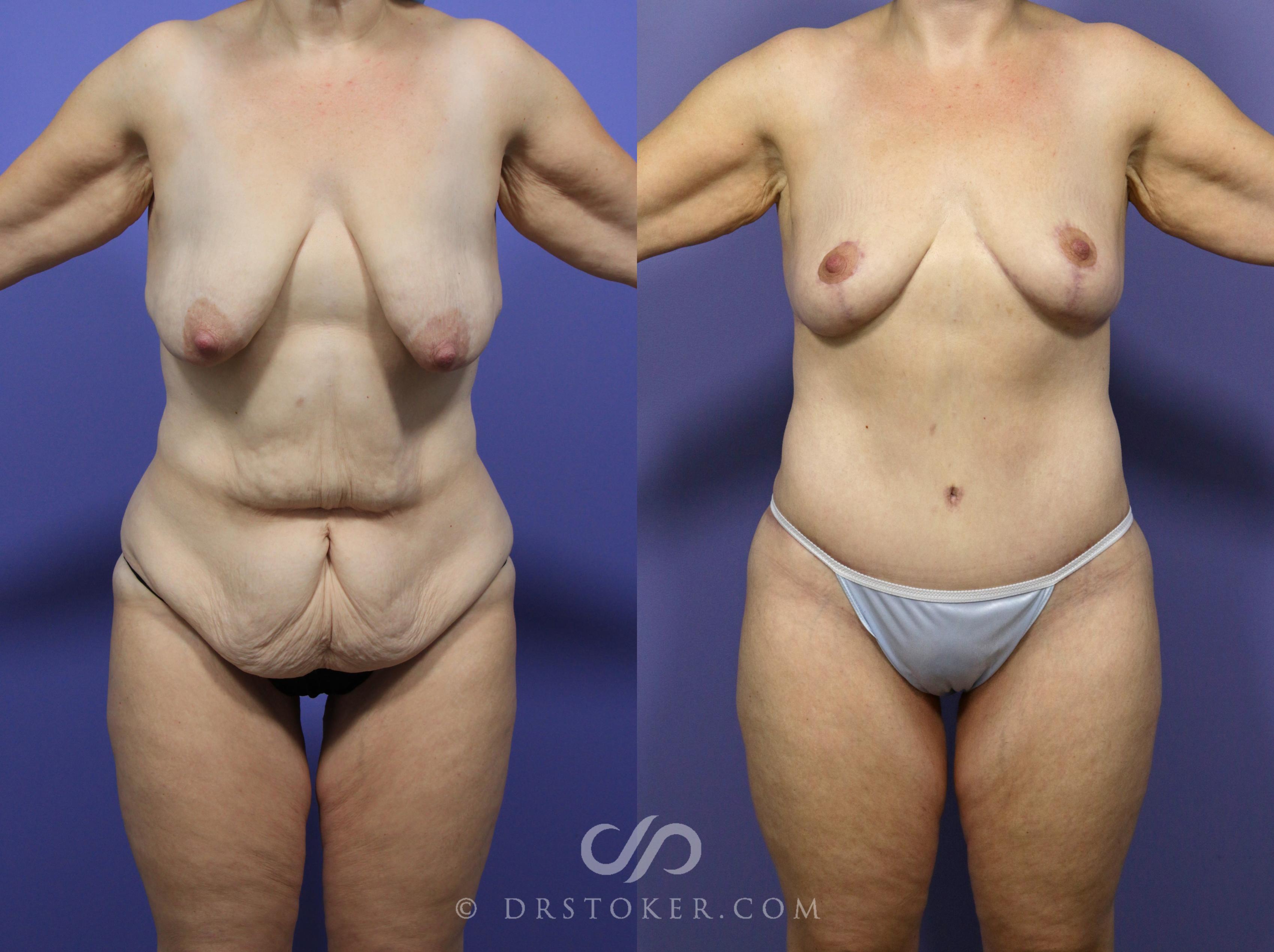 Before & After After Weight Loss Case 1148 View #1 View in Los Angeles, CA