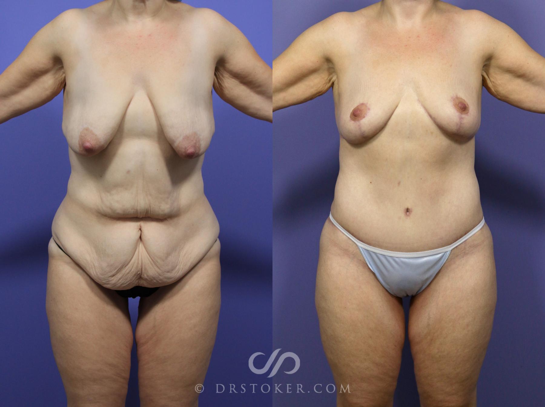 Before & After After Weight Loss Case 1148 View #1 View in Los Angeles, CA