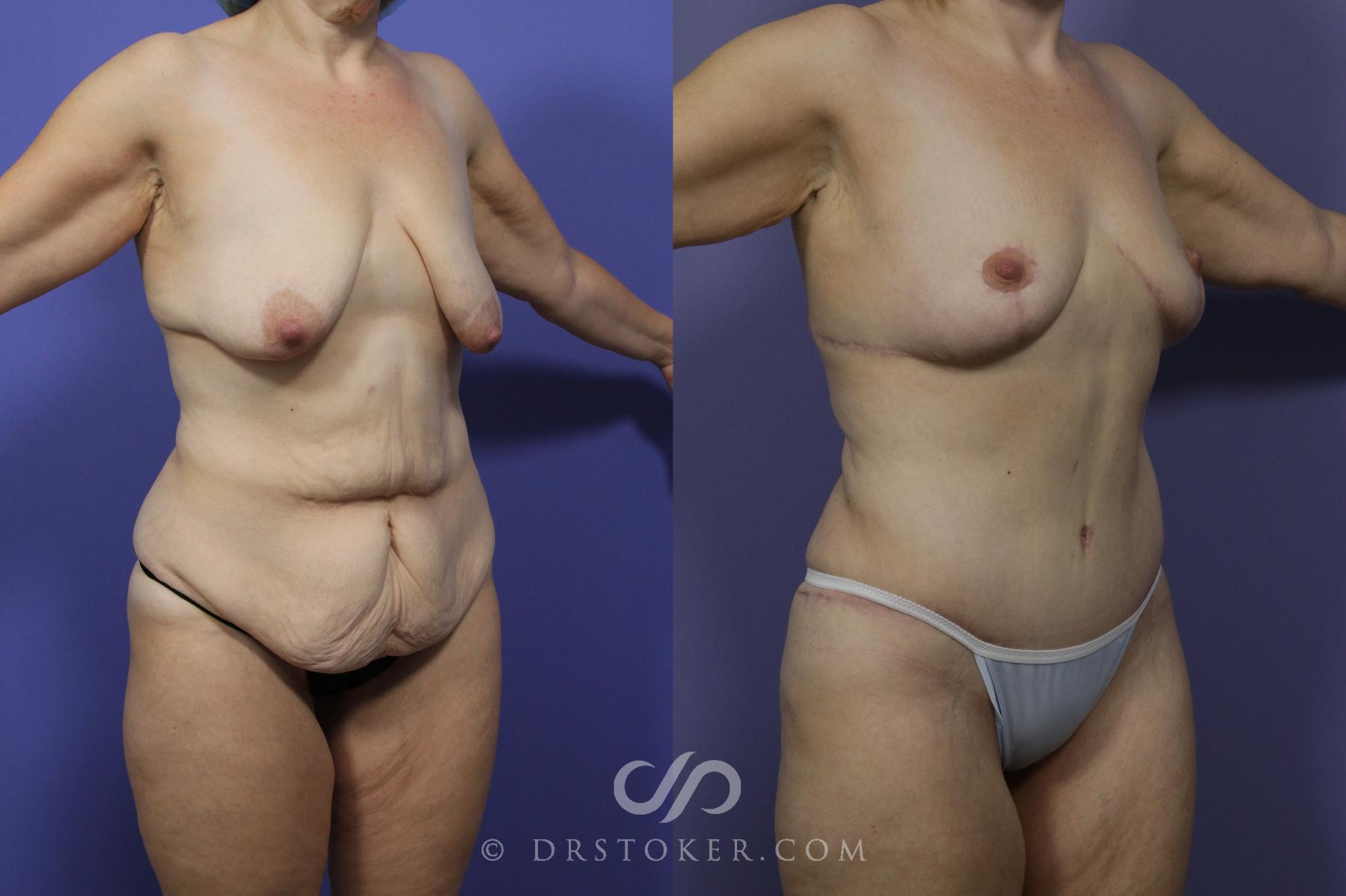 Before & After After Weight Loss Case 1148 View #2 View in Los Angeles, CA