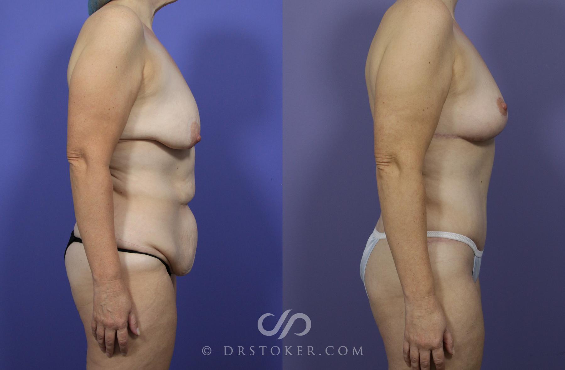 Before & After After Weight Loss Case 1148 View #3 View in Los Angeles, CA