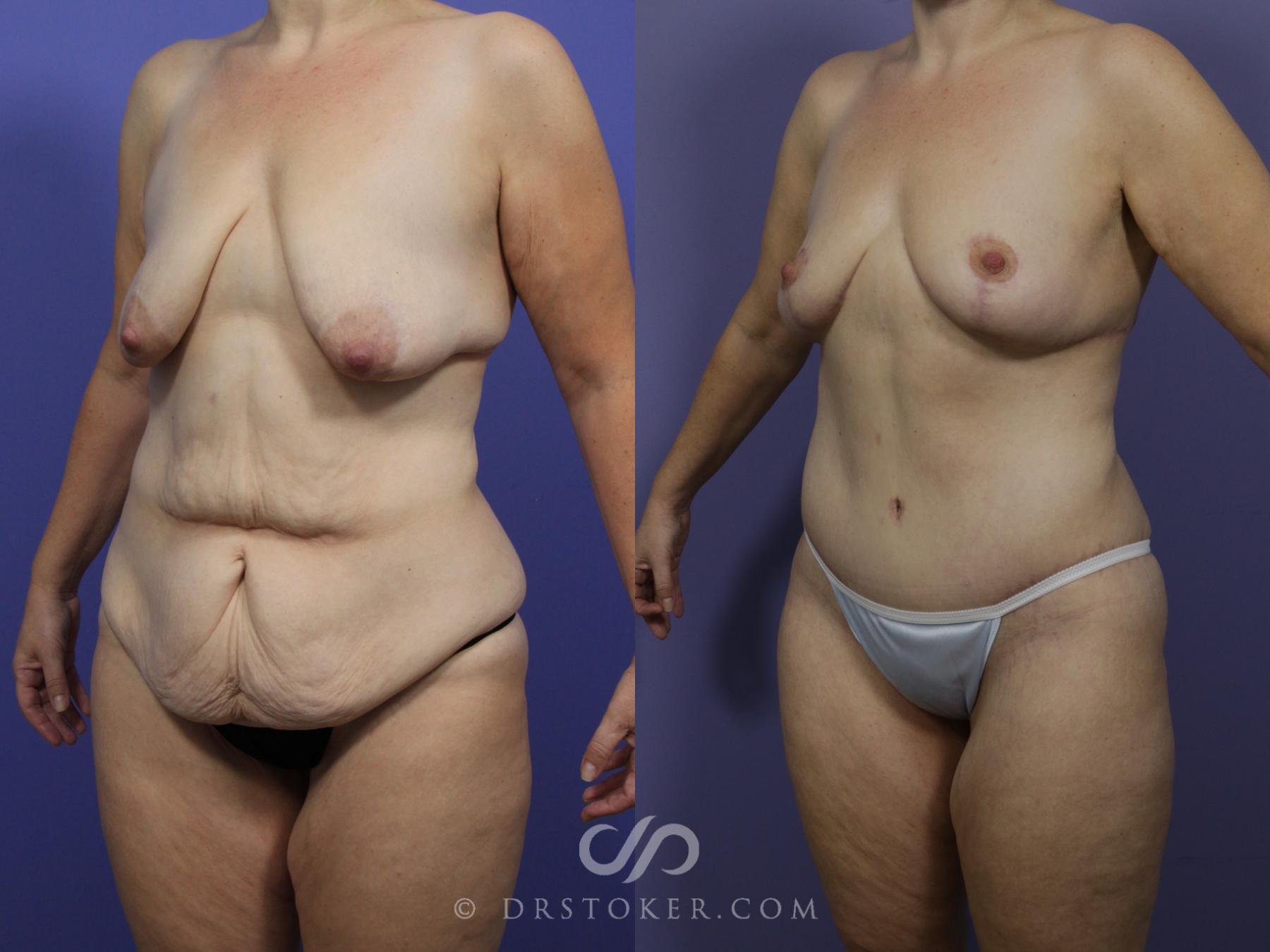 Before & After After Weight Loss Case 1197 View #1 View in Los Angeles, CA