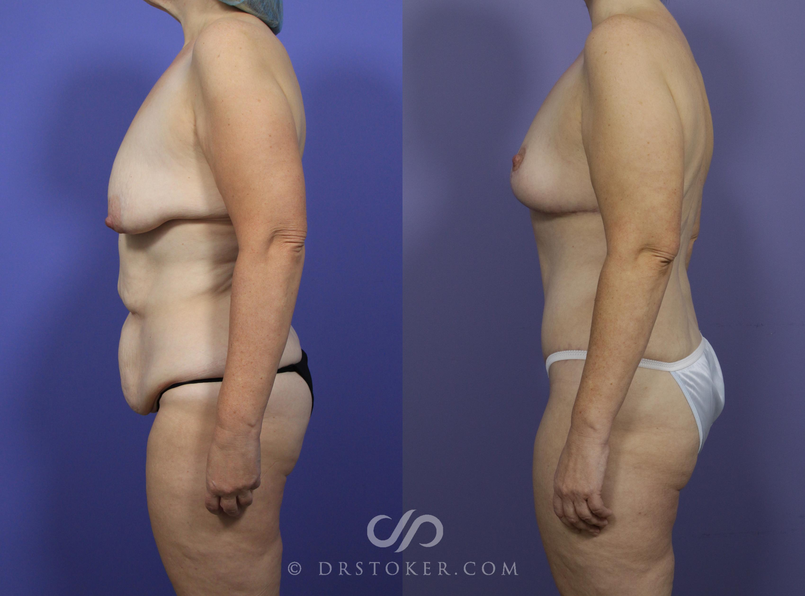 Before & After After Weight Loss Case 1197 View #2 View in Los Angeles, CA