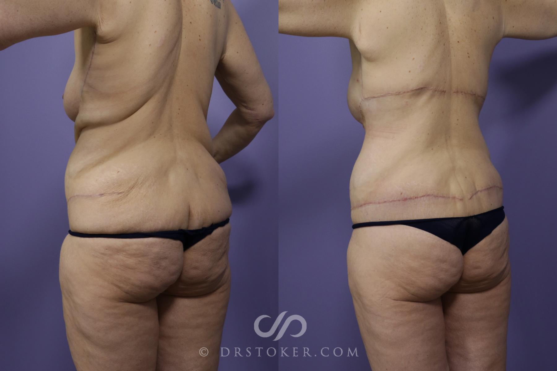 Before & After Back Lift (Bra Line Back Lift) Case 1248 View #2 View in Los Angeles, CA