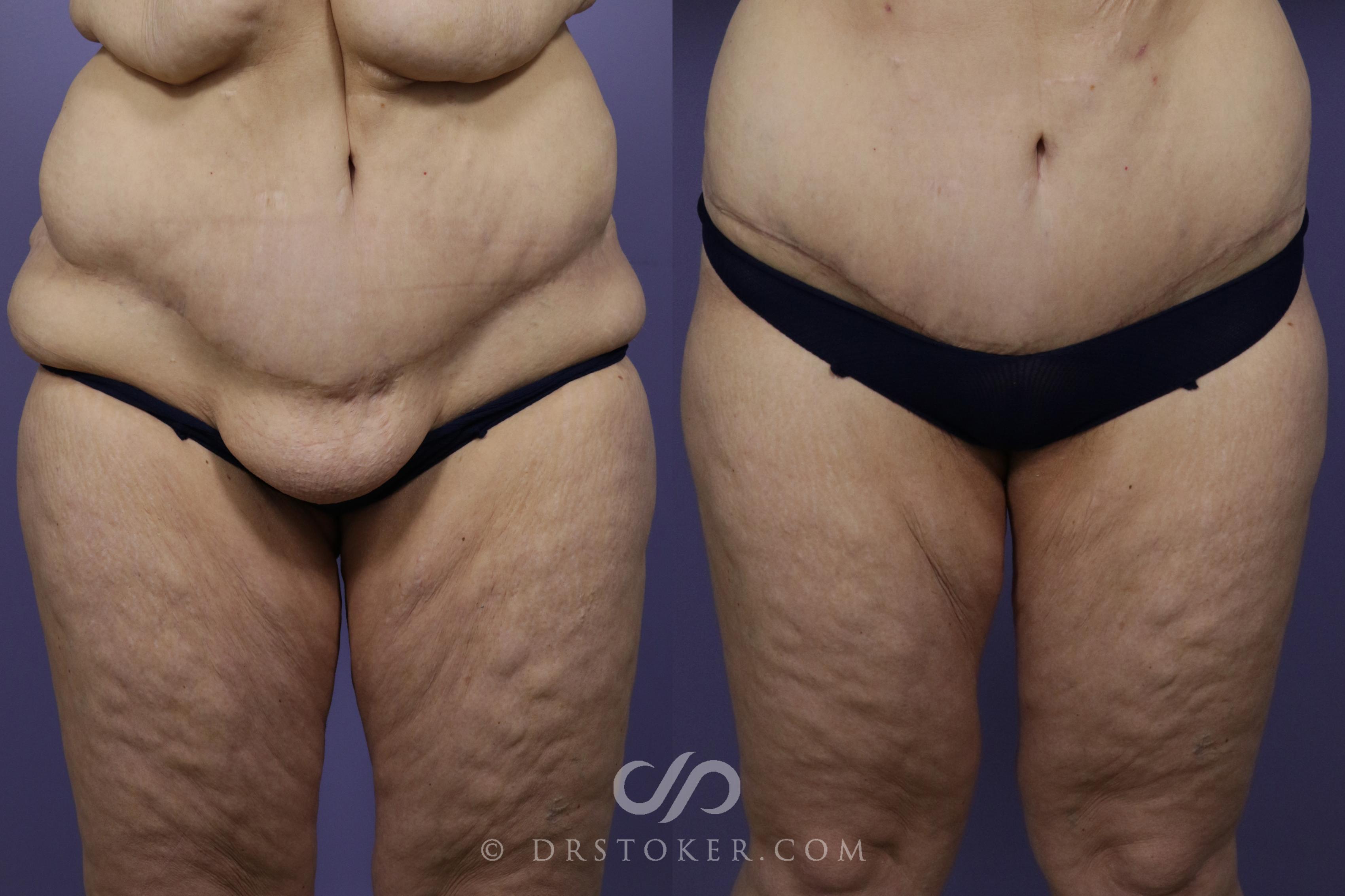 Before & After After Weight Loss Case 1249 View #1 View in Los Angeles, CA
