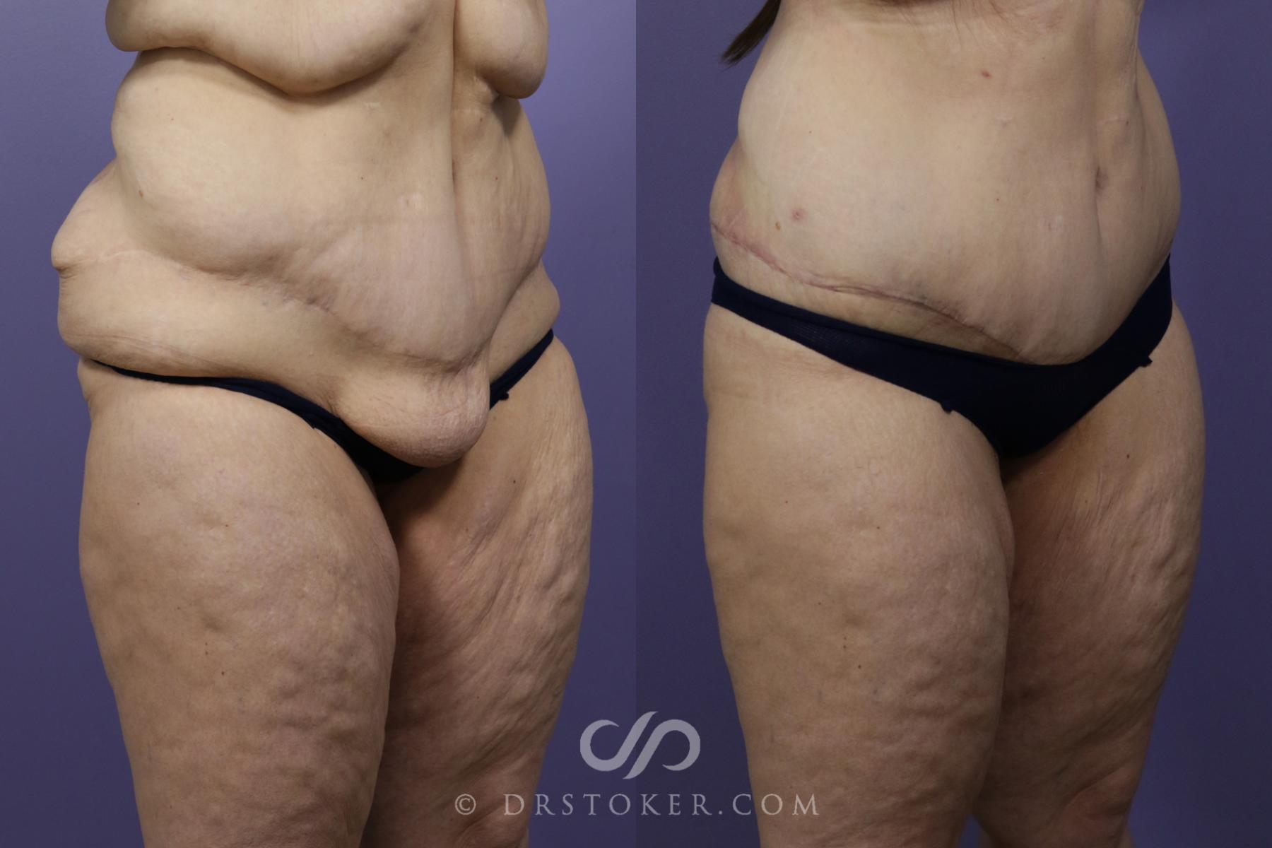 Before & After After Weight Loss Case 1249 View #2 View in Los Angeles, CA