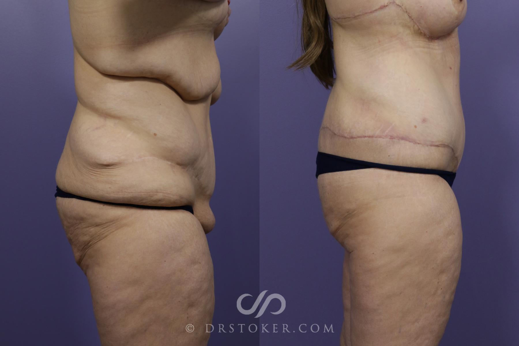Before & After After Weight Loss Case 1249 View #3 View in Los Angeles, CA