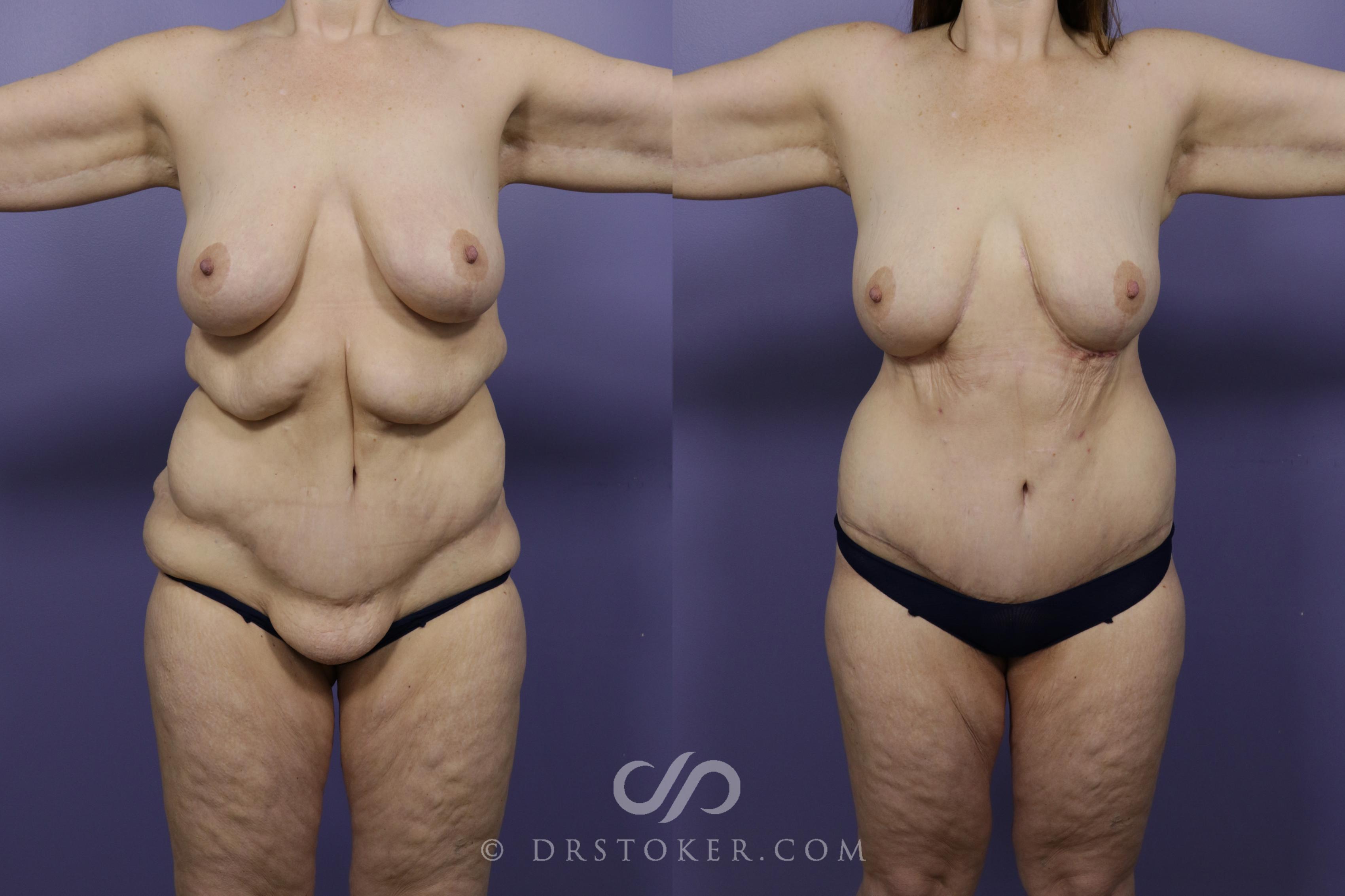 Before & After After Weight Loss Case 1250 View #1 View in Los Angeles, CA