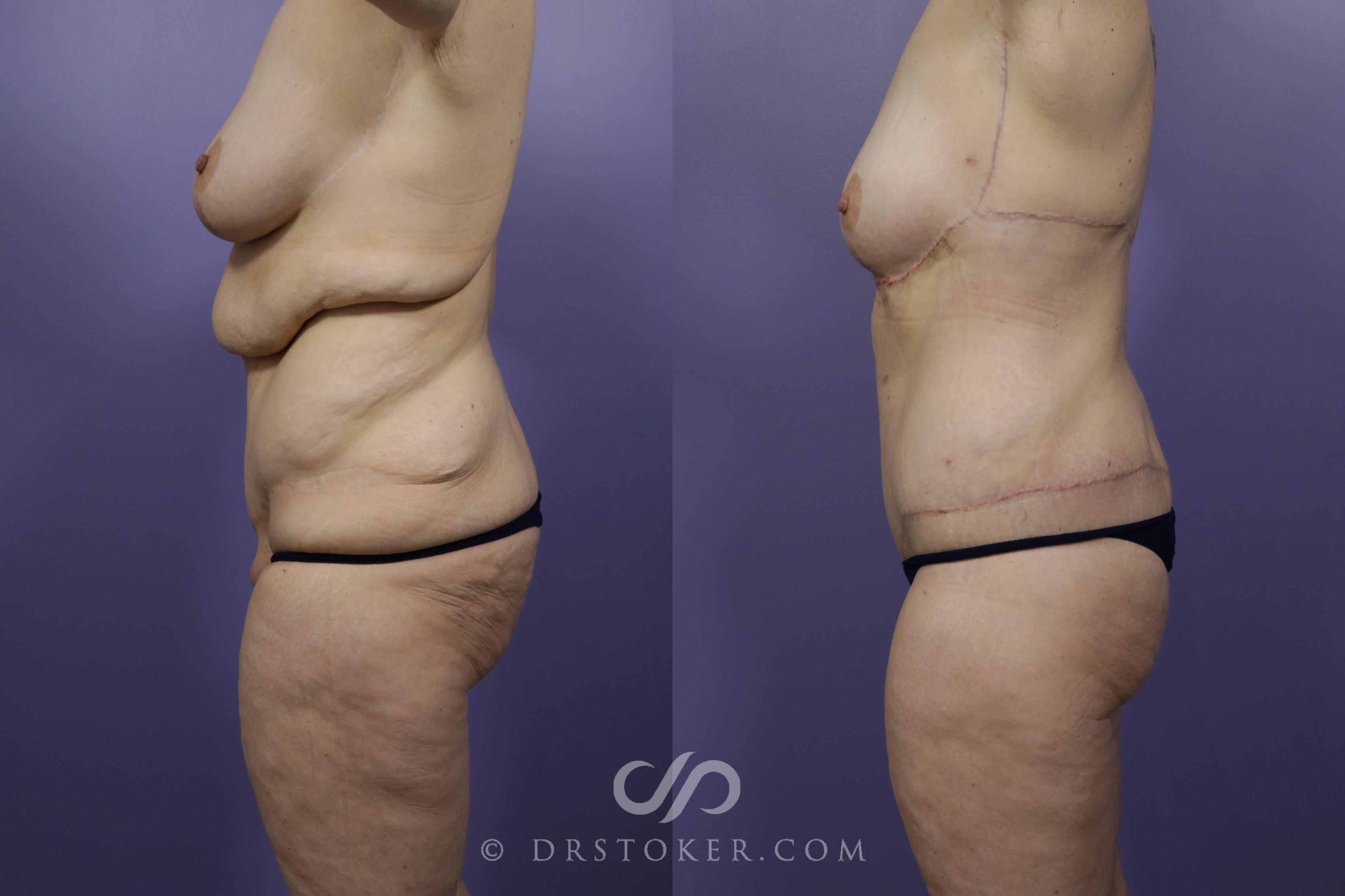 Before & After After Weight Loss Case 1250 View #2 View in Los Angeles, CA