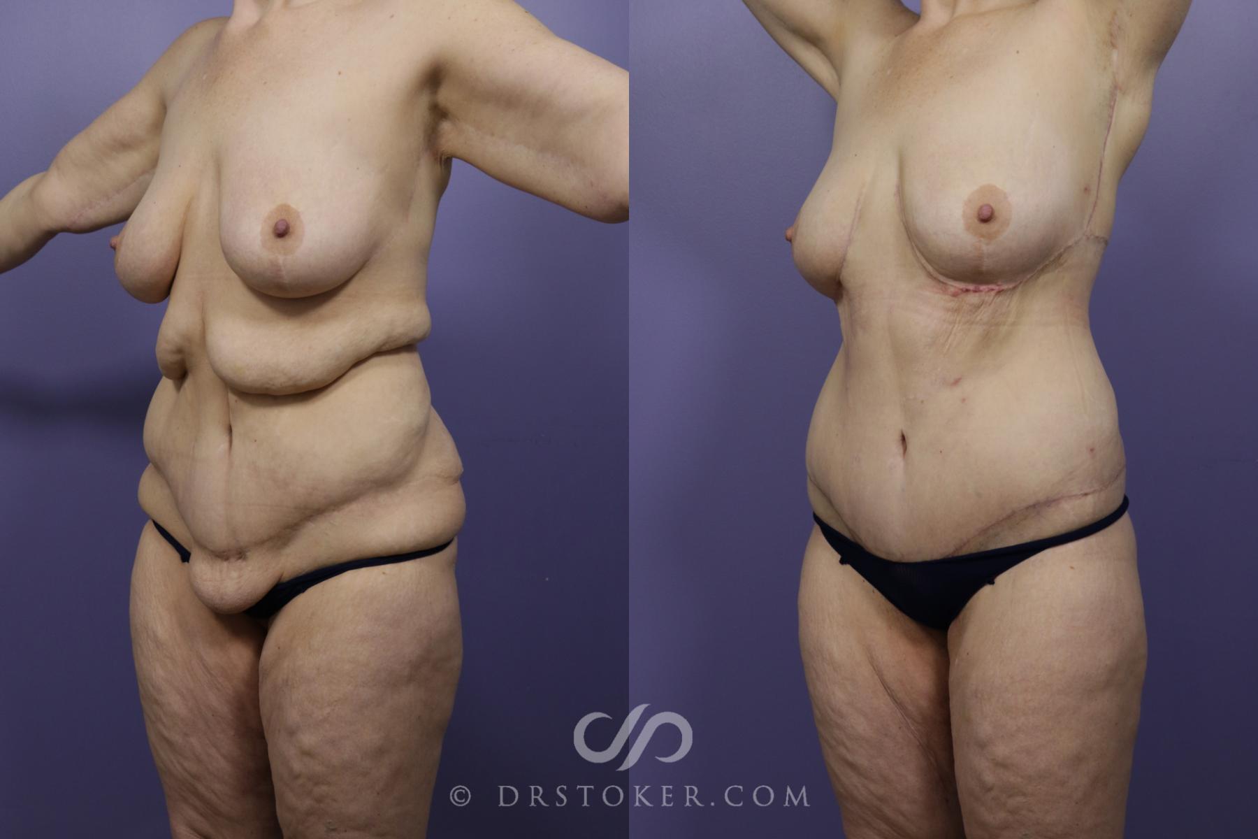 Before & After After Weight Loss Case 1250 View #3 View in Los Angeles, CA