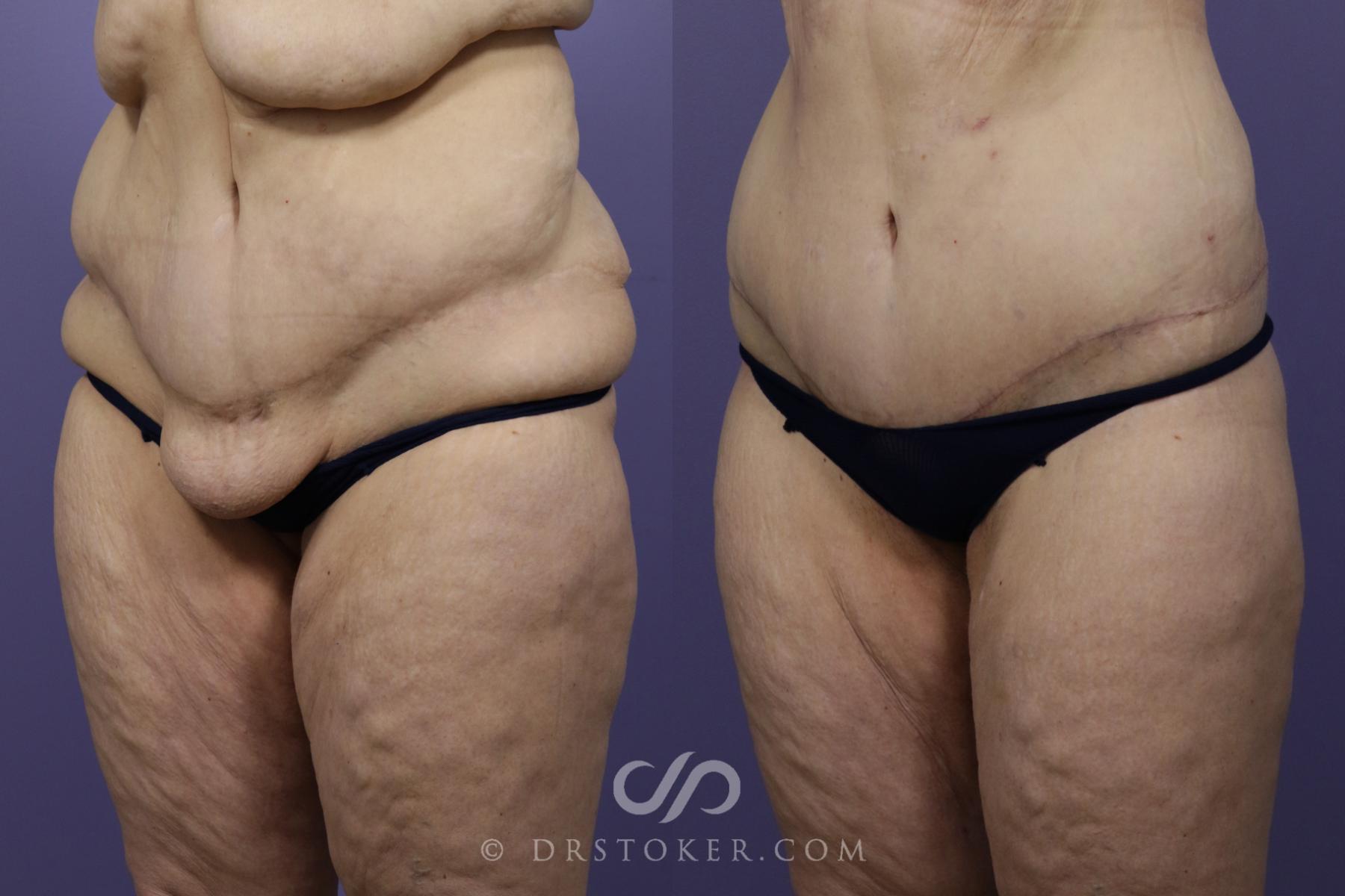 Before & After After Weight Loss Case 1251 View #1 View in Los Angeles, CA