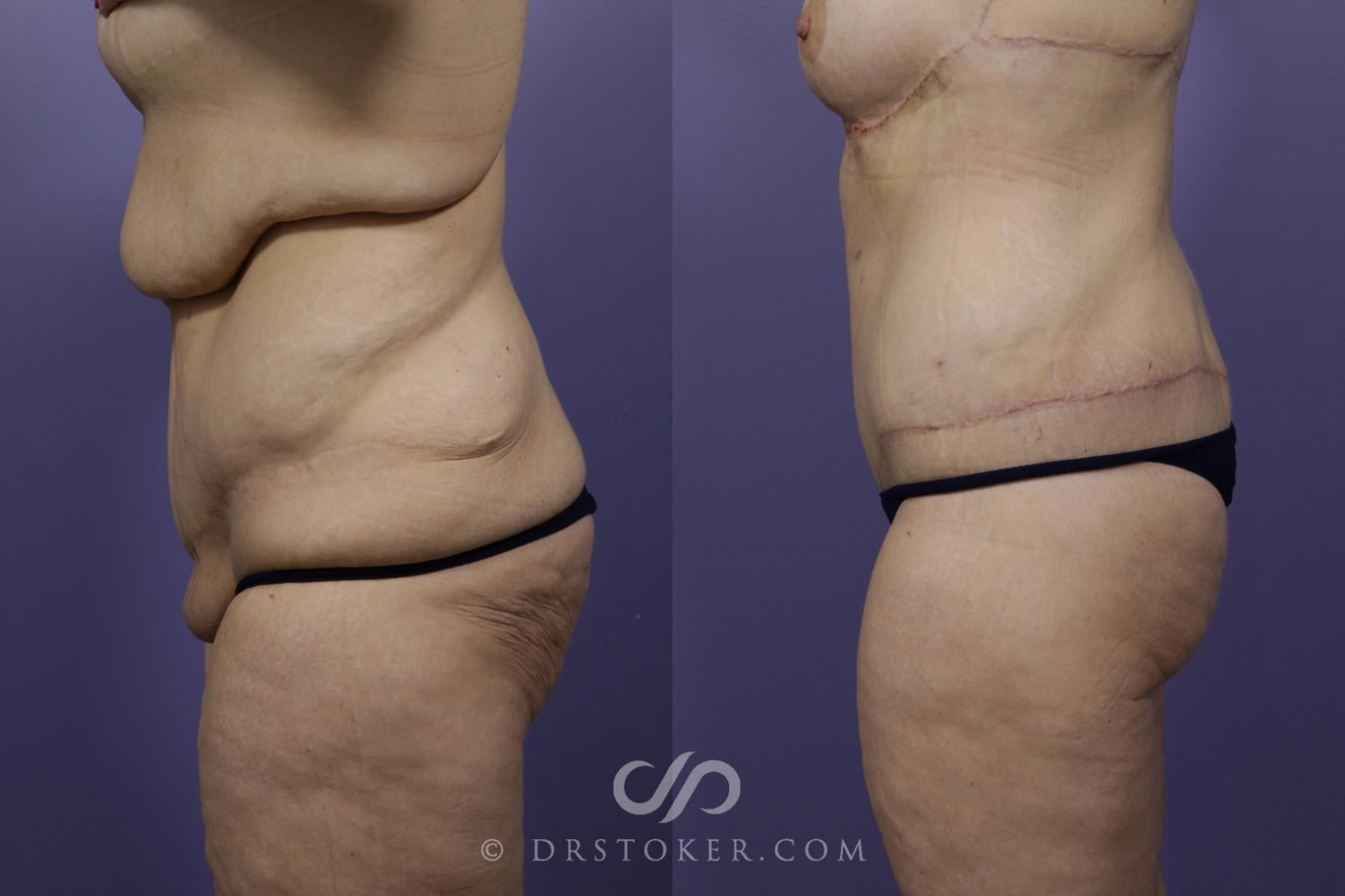 Before & After After Weight Loss Case 1251 View #2 View in Los Angeles, CA