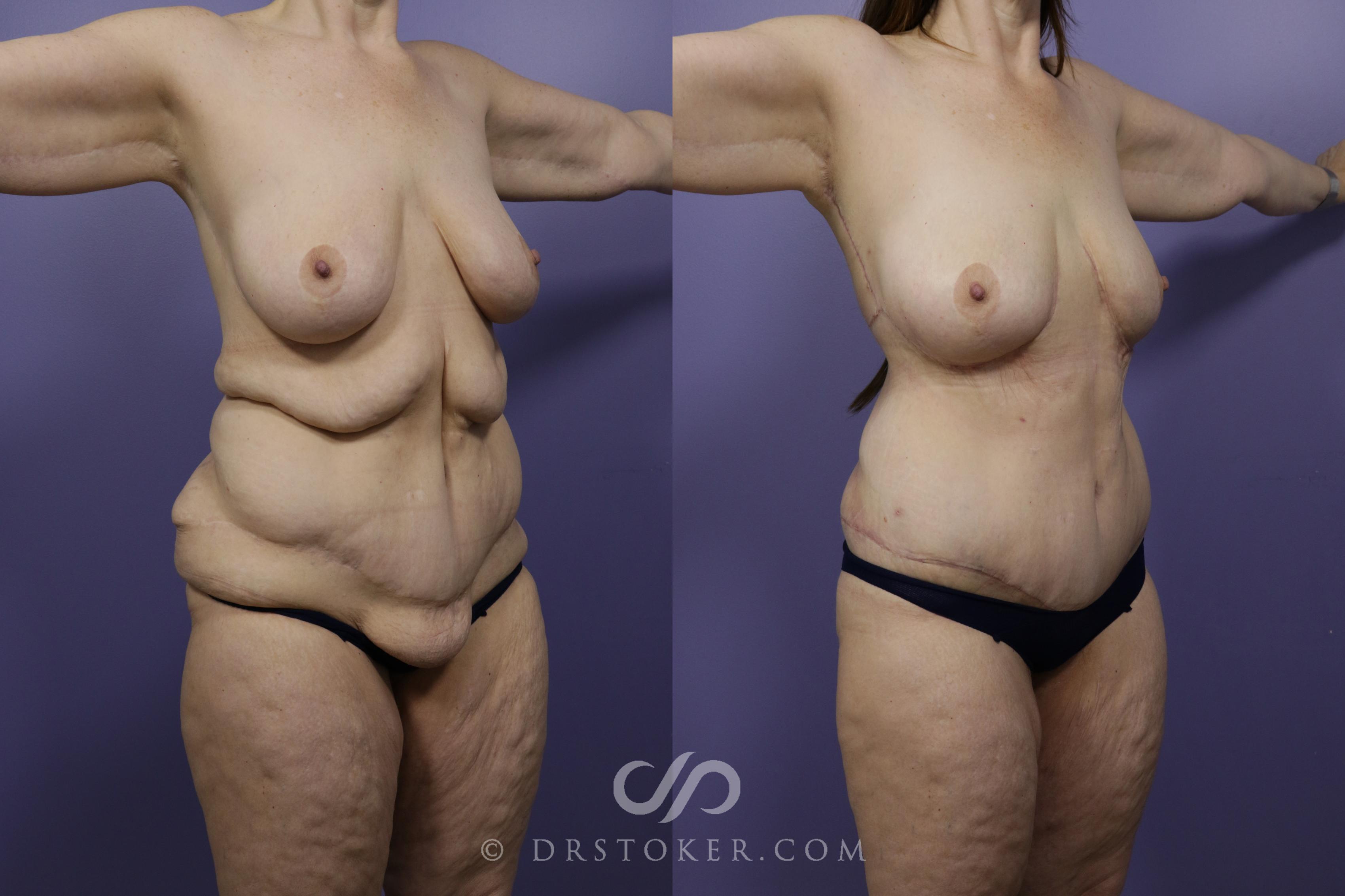 Before & After After Weight Loss Case 1252 View #1 View in Los Angeles, CA