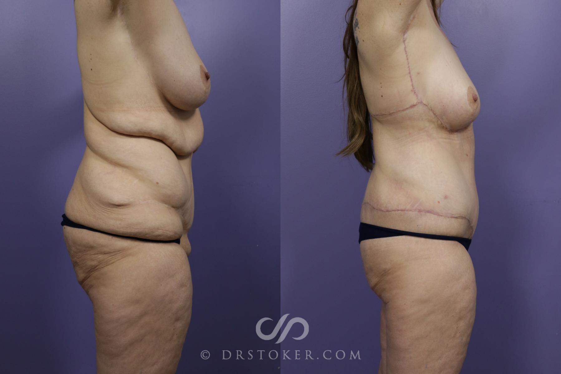 Before & After After Weight Loss Case 1252 View #2 View in Los Angeles, CA
