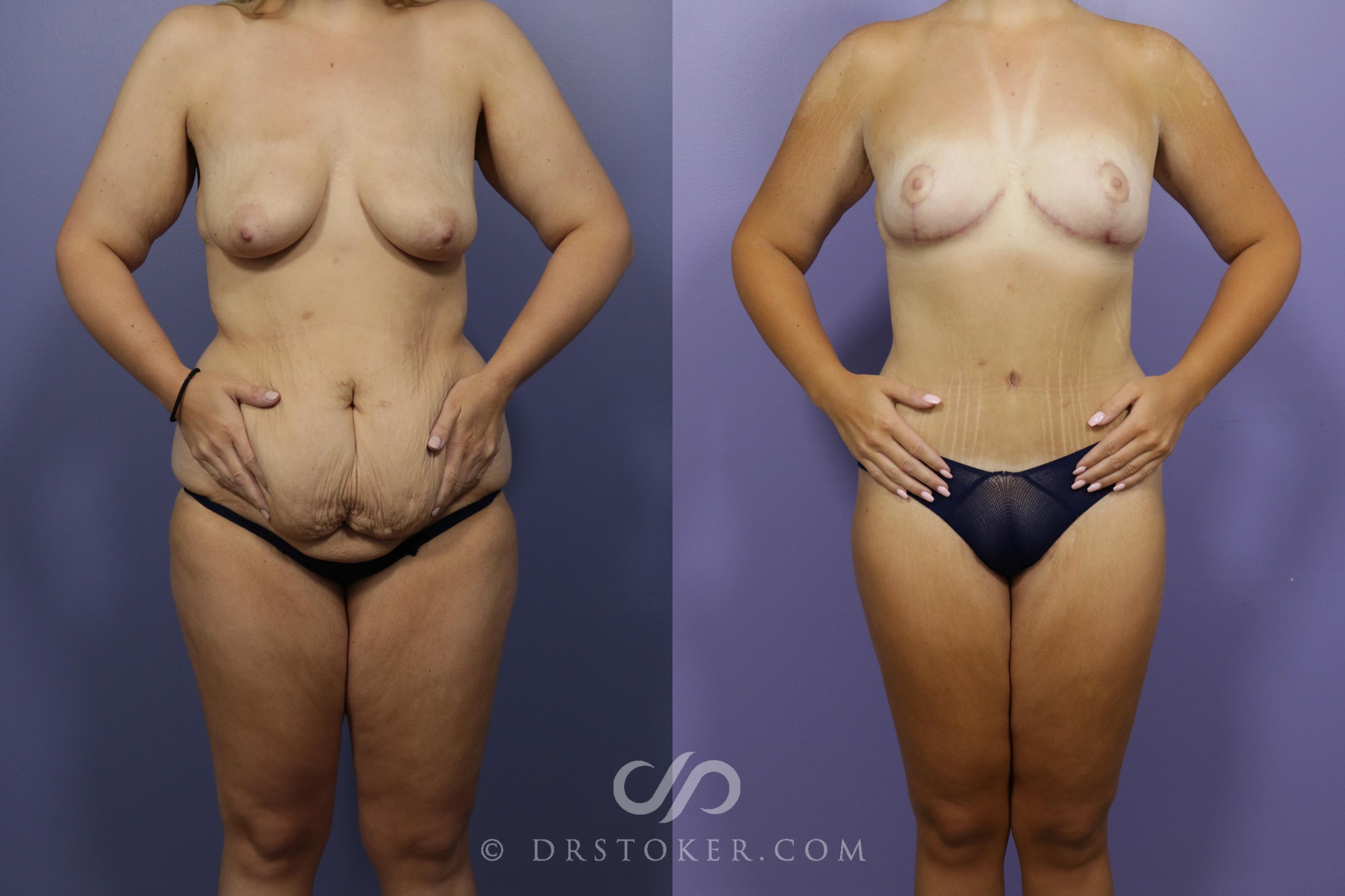 Before & After After Weight Loss Case 1375 View #1 View in Los Angeles, CA