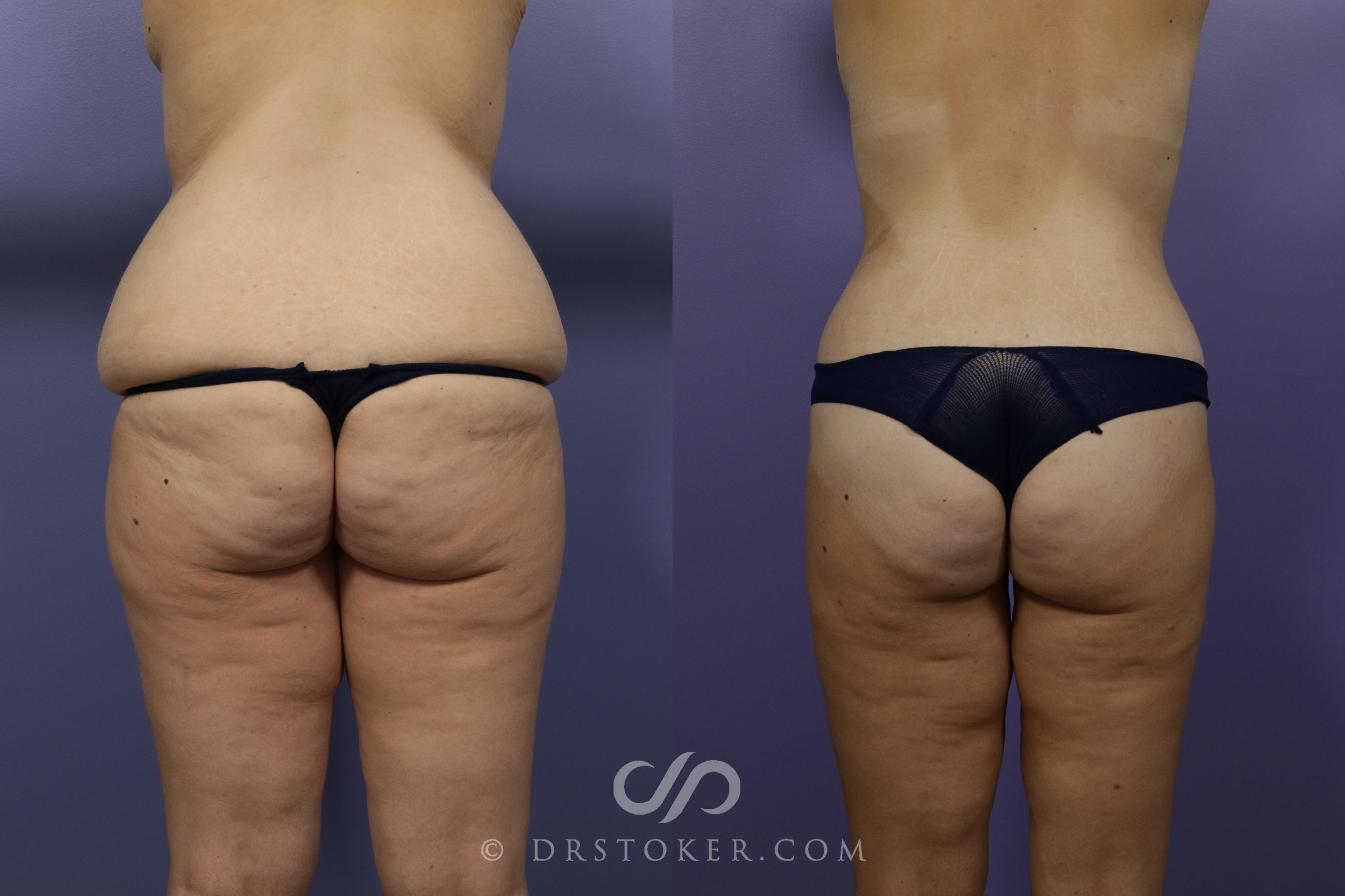 Before & After After Weight Loss Case 1376 View #1 View in Los Angeles, CA