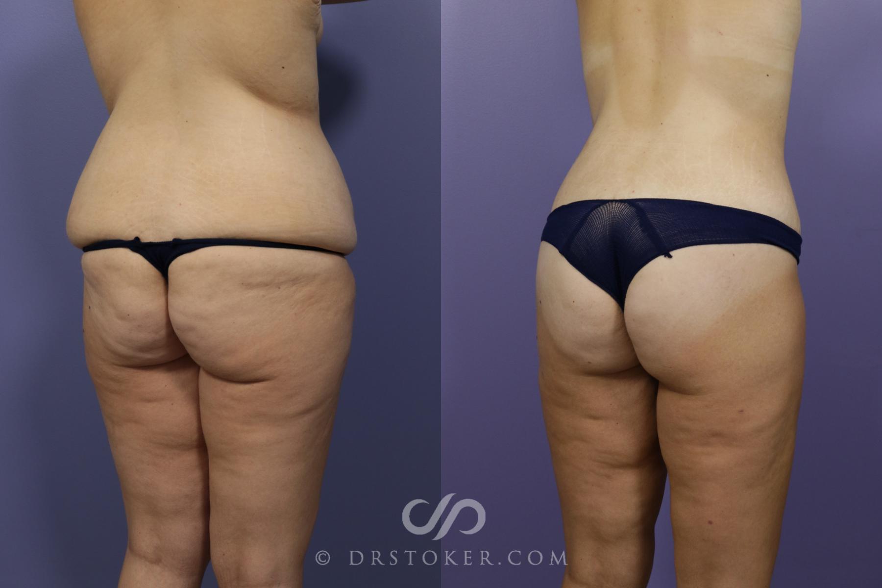 Before & After After Weight Loss Case 1376 View #2 View in Los Angeles, CA