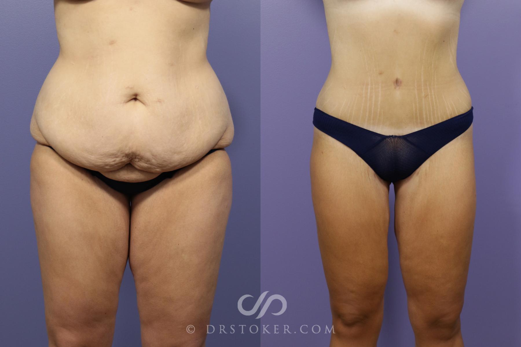 Before & After After Weight Loss Case 1376 View #3 View in Los Angeles, CA