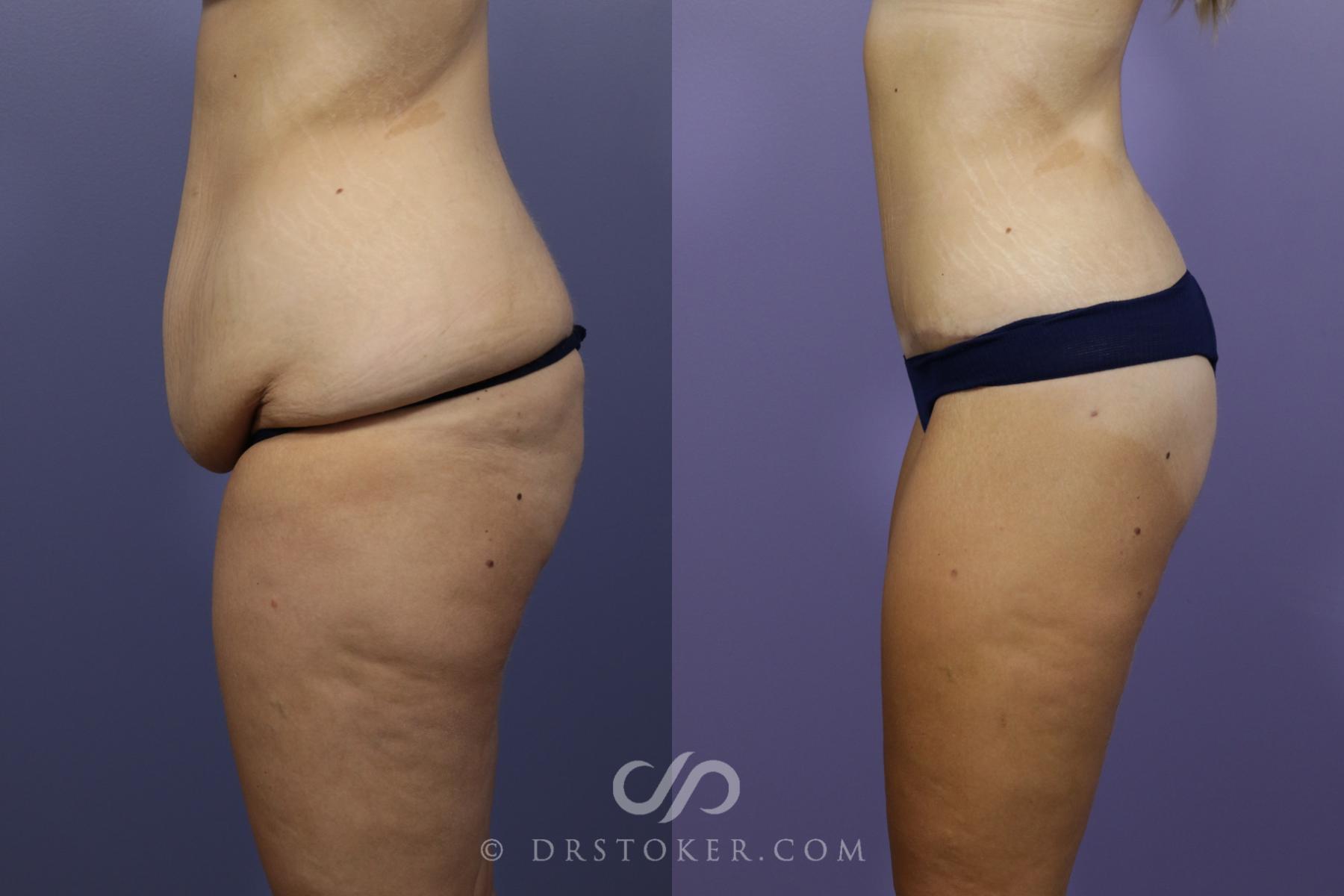 Before & After After Weight Loss Case 1376 View #4 View in Los Angeles, CA