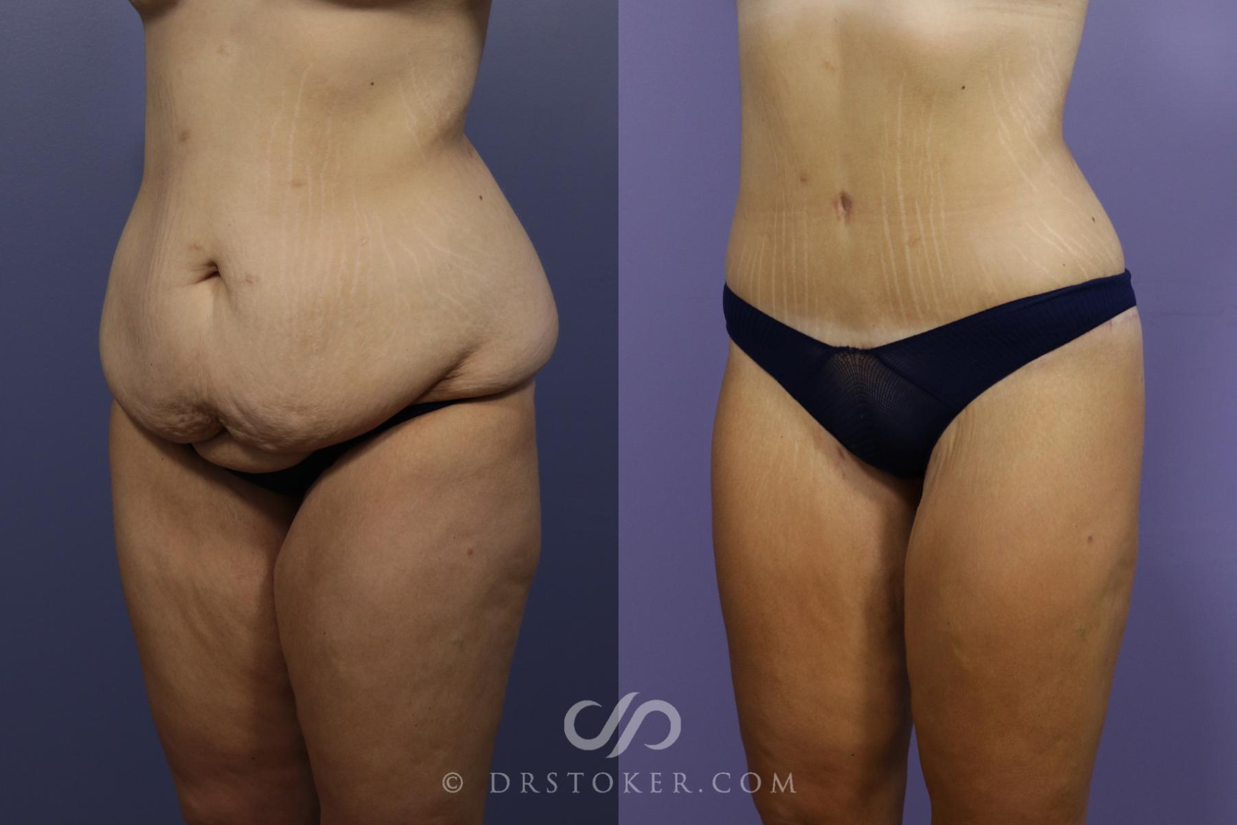 Before & After After Weight Loss Case 1376 View #5 View in Los Angeles, CA