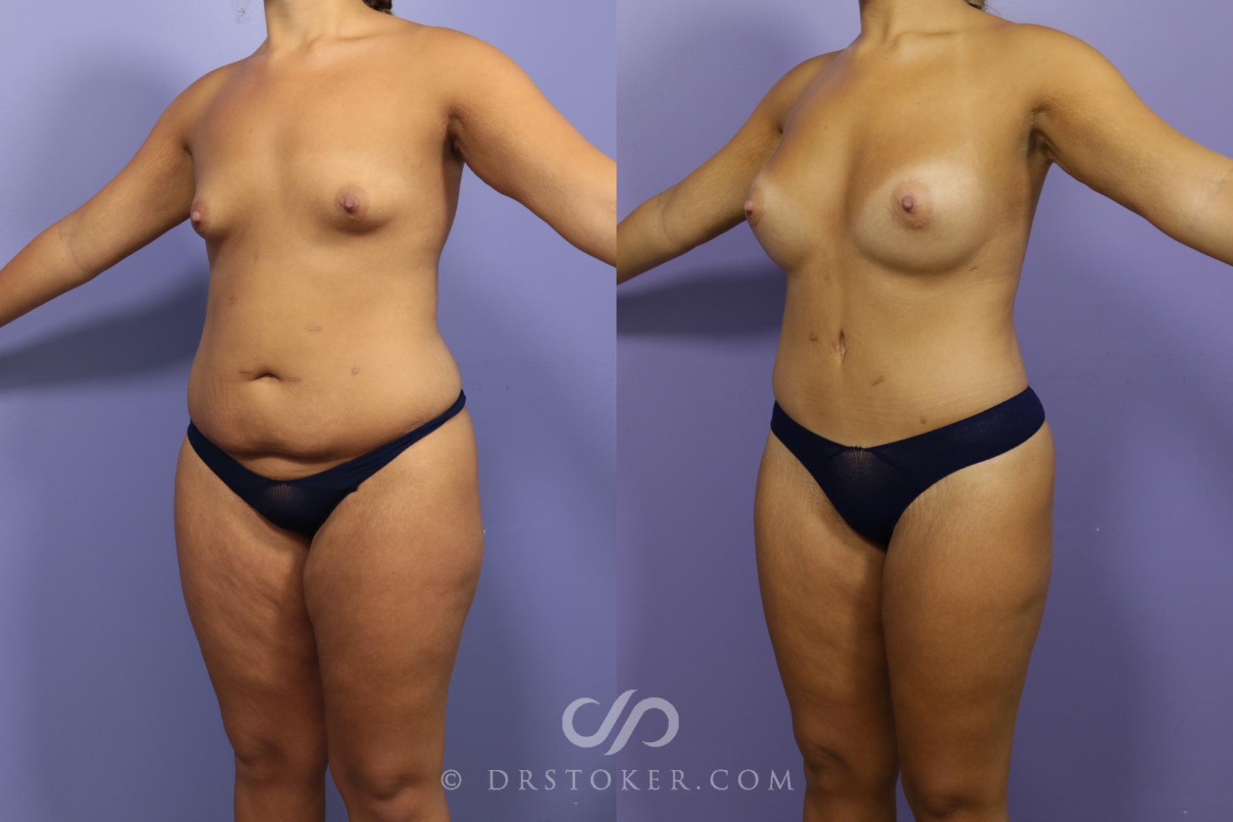 Before & After After Weight Loss Case 1386 View #1 View in Los Angeles, CA