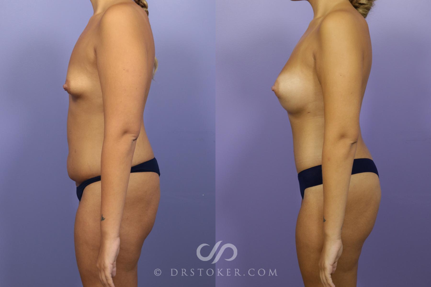 Before & After After Weight Loss Case 1386 View #2 View in Los Angeles, CA