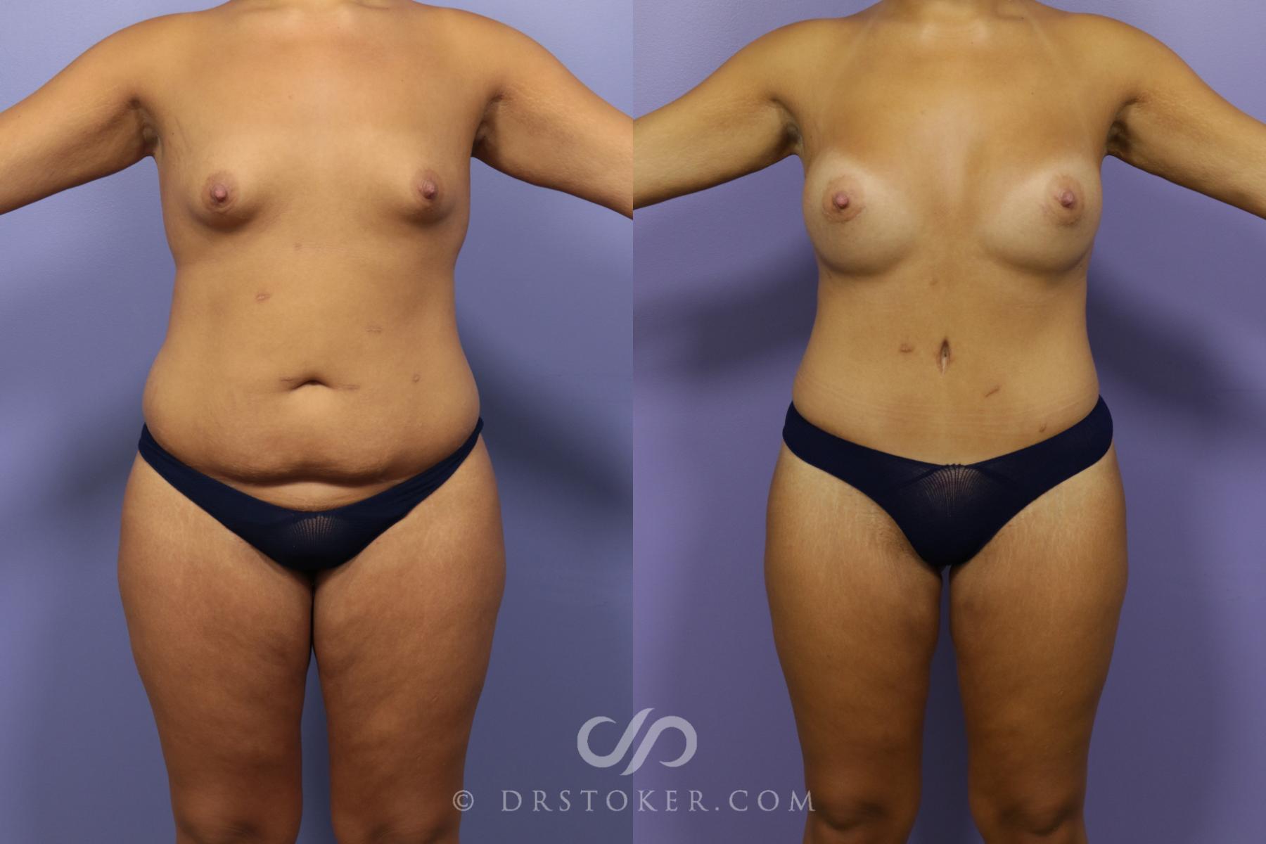 Before & After After Weight Loss Case 1387 View #1 View in Los Angeles, CA