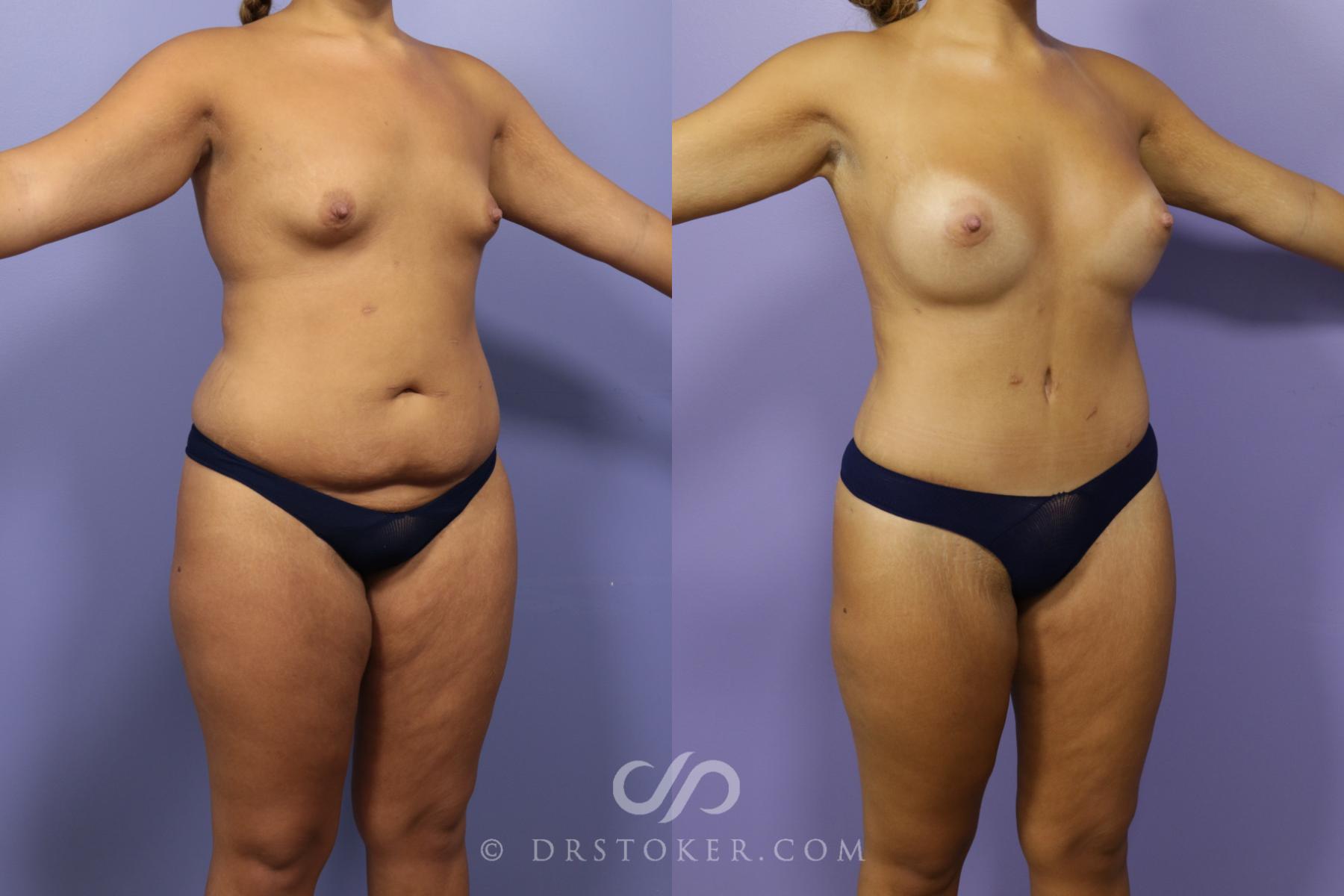 Before & After After Weight Loss Case 1387 View #2 View in Los Angeles, CA