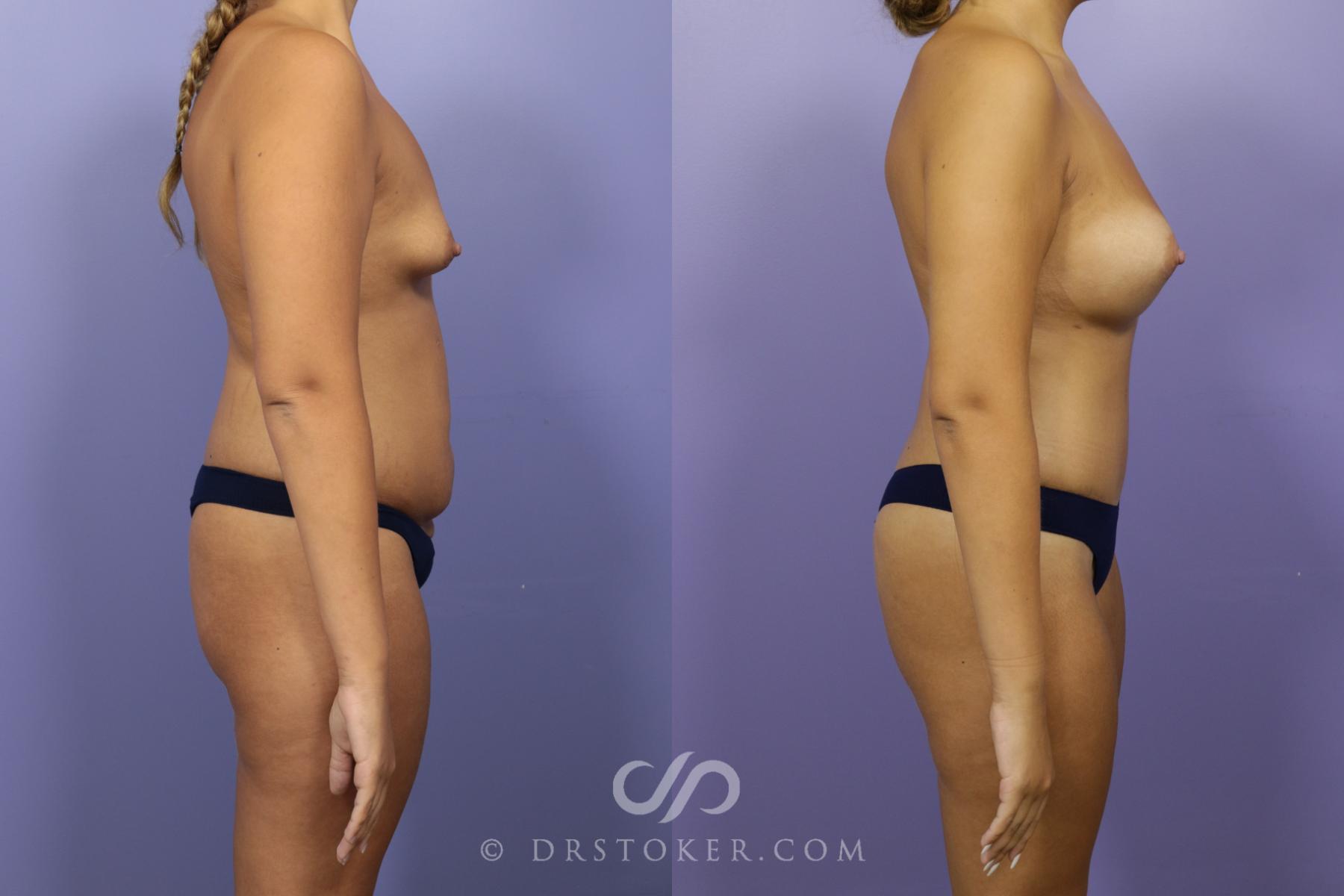 Before & After After Weight Loss Case 1387 View #3 View in Los Angeles, CA