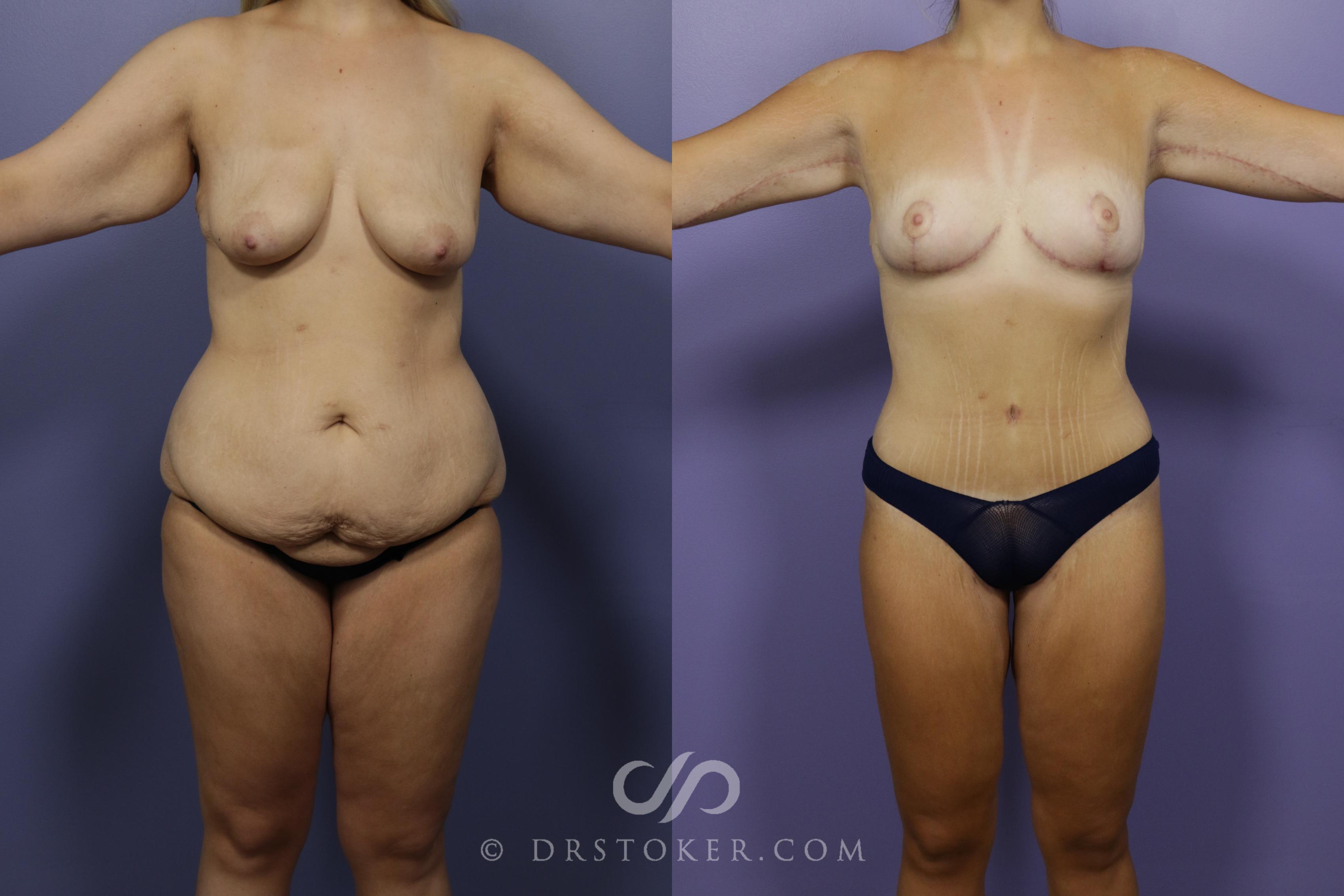 Before & After After Weight Loss Case 1388 View #1 View in Los Angeles, CA
