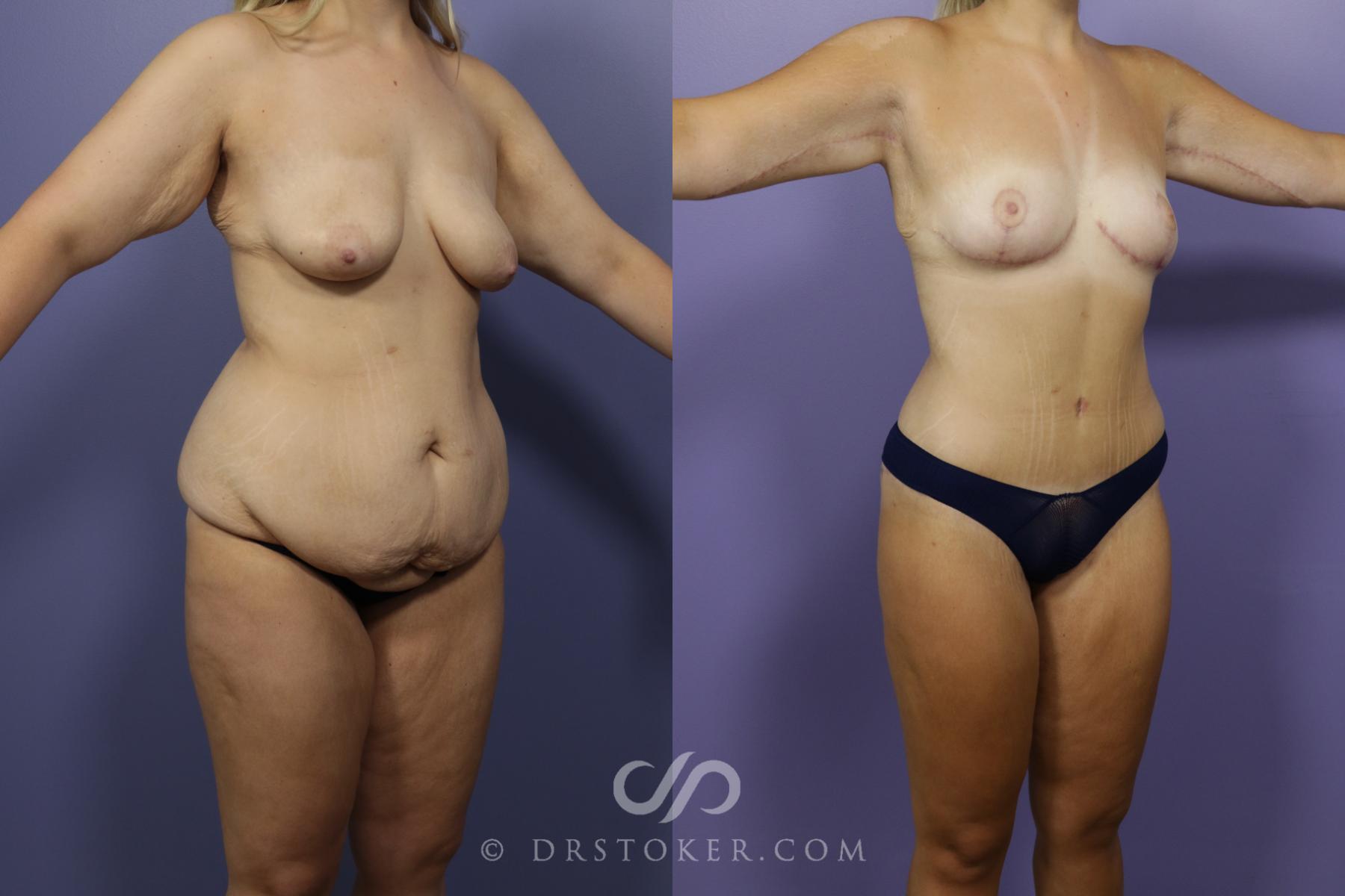 Before & After After Weight Loss Case 1388 View #2 View in Los Angeles, CA