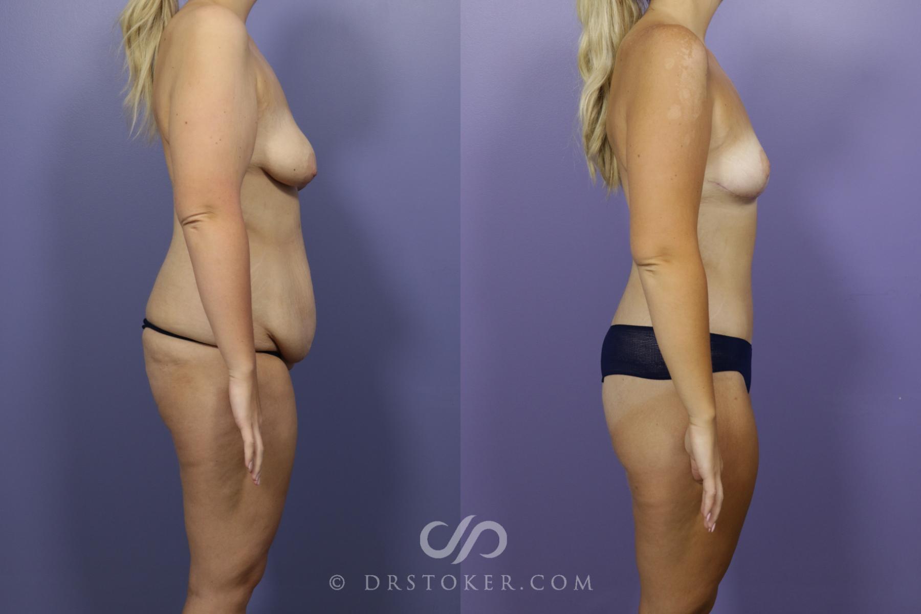 Before & After After Weight Loss Case 1388 View #3 View in Los Angeles, CA