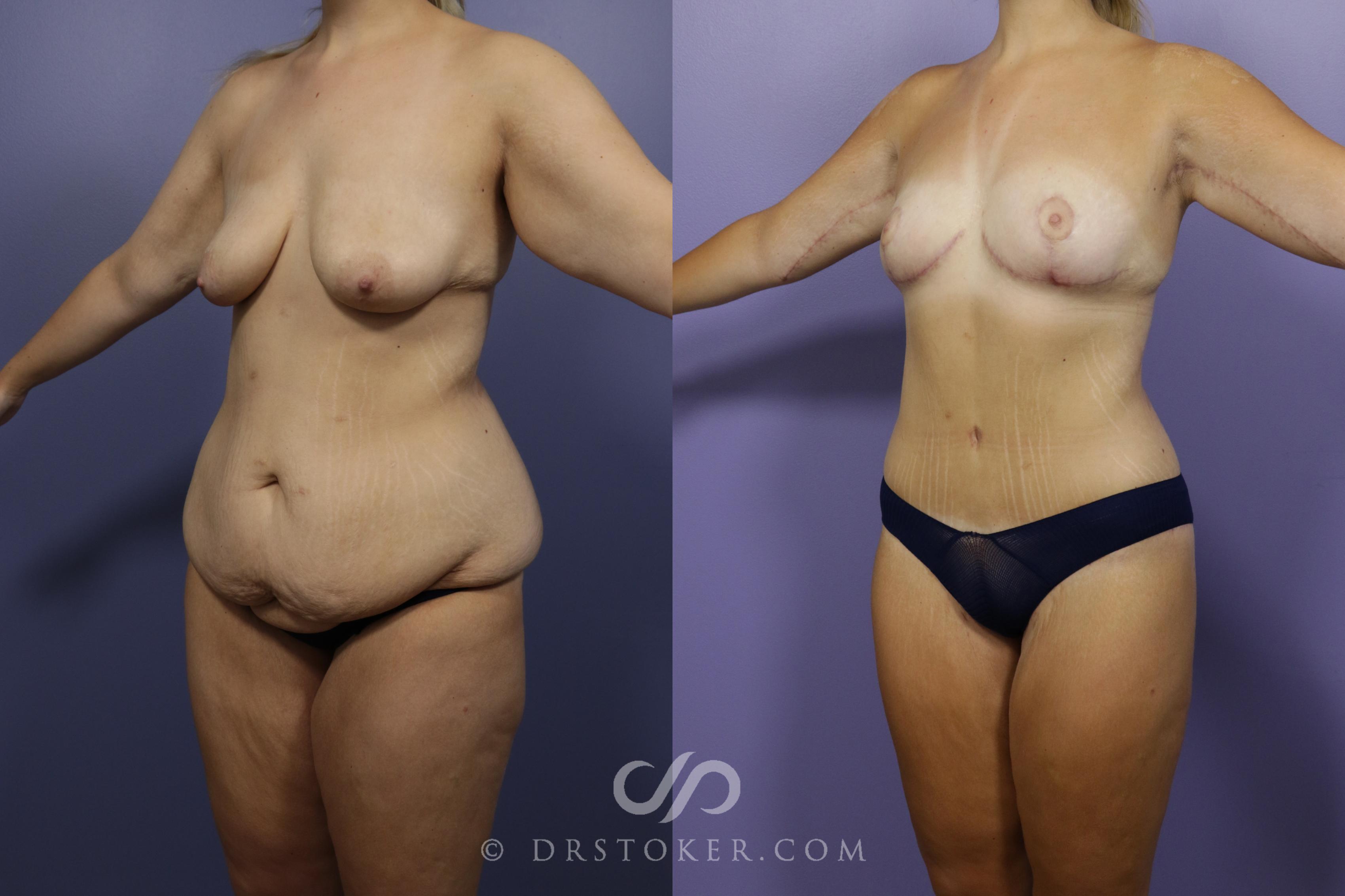 Before & After After Weight Loss Case 1389 View #2 View in Los Angeles, CA