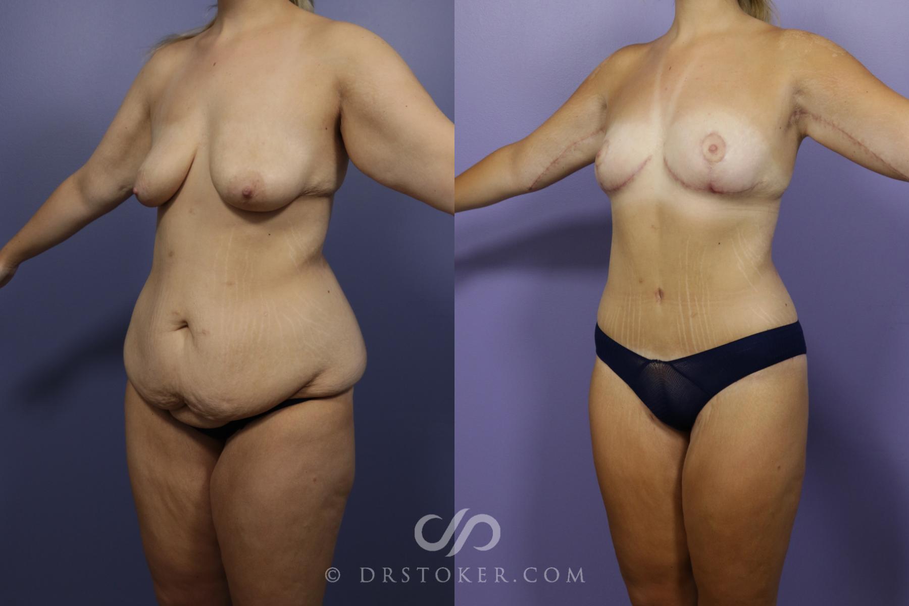 Before & After After Weight Loss Case 1389 View #2 View in Los Angeles, CA