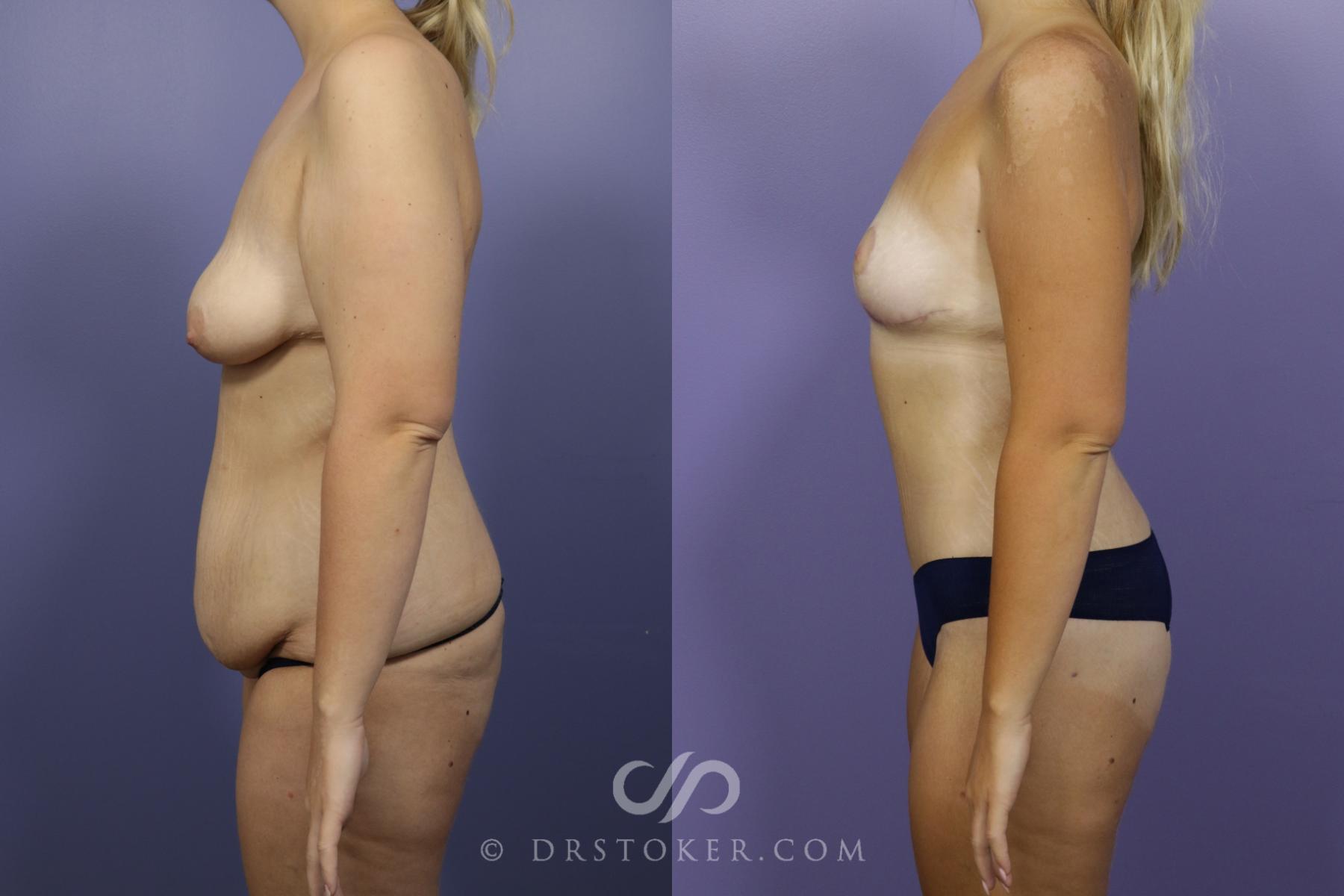 Before & After After Weight Loss Case 1389 View #3 View in Los Angeles, CA